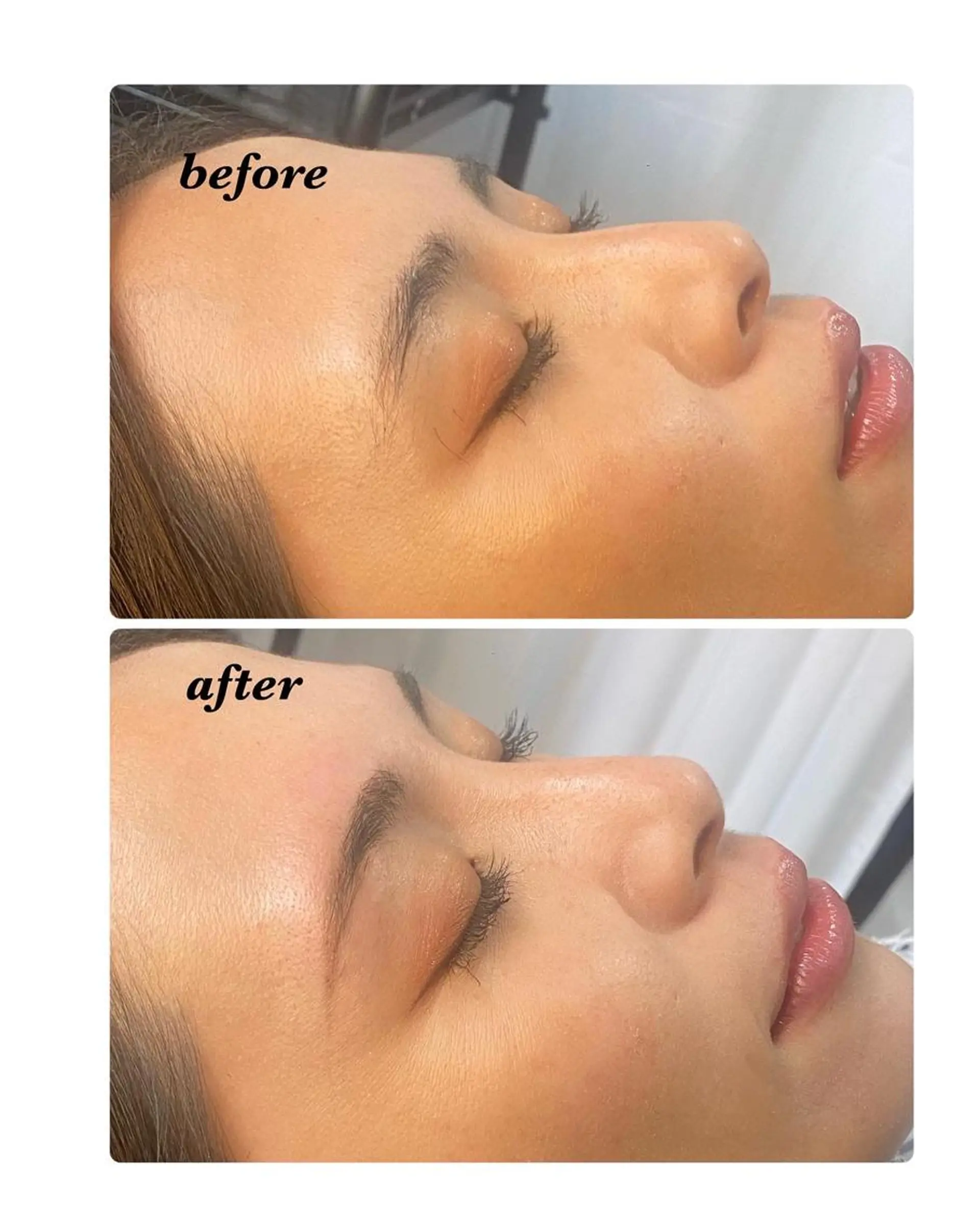 アイブロウ ハーブピーリング/韓国肌管理/フェイシャル/毛穴洗浄/眉毛/顔脱毛【糸脱毛専門】rev所属・ハーブピーリング🌹 毛穴洗浄❤️眉waxのエステ・リラクイメージ