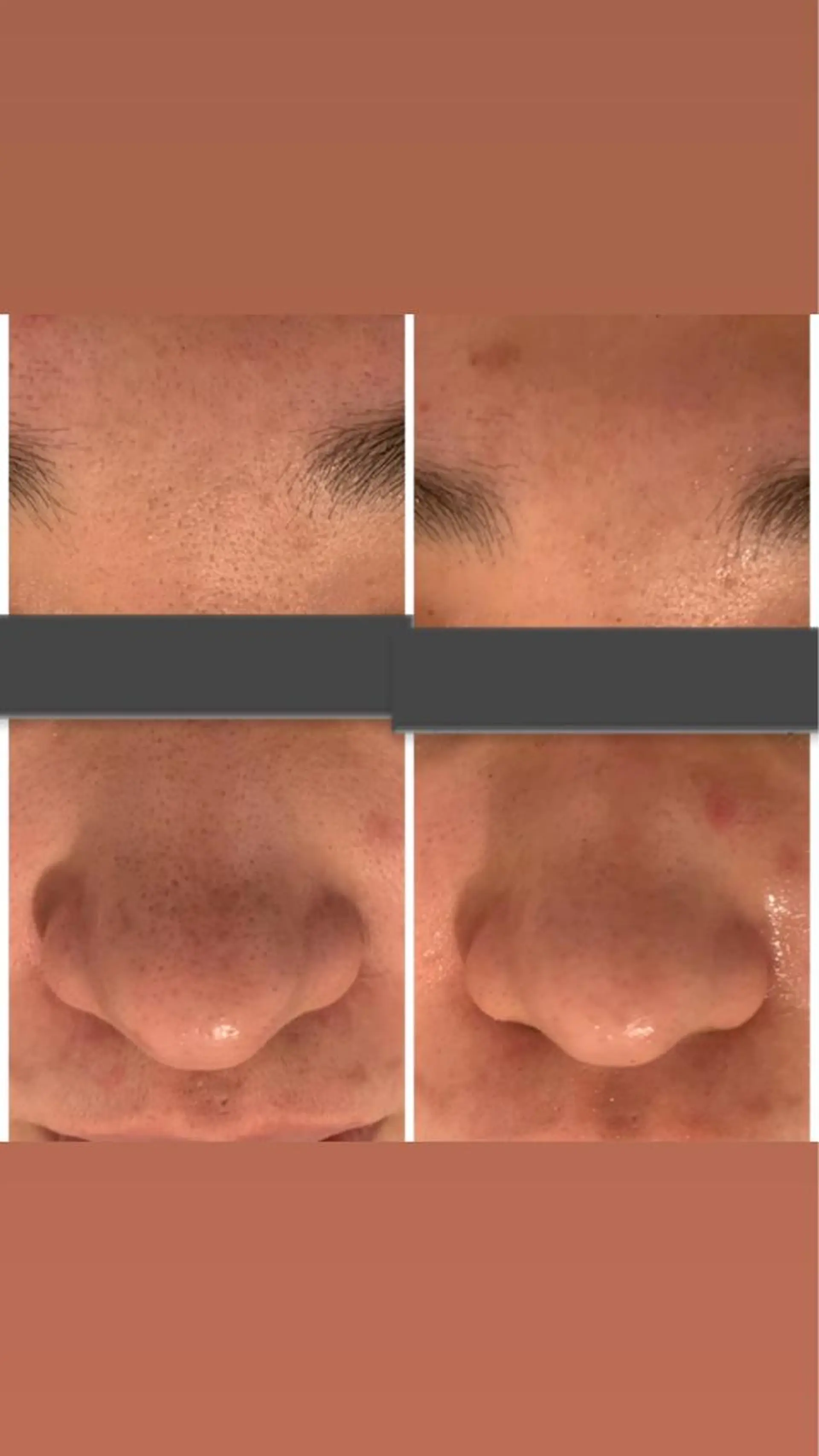 肌質改善ハーブピー リング🌿RINAのエステ・リラクイメージ