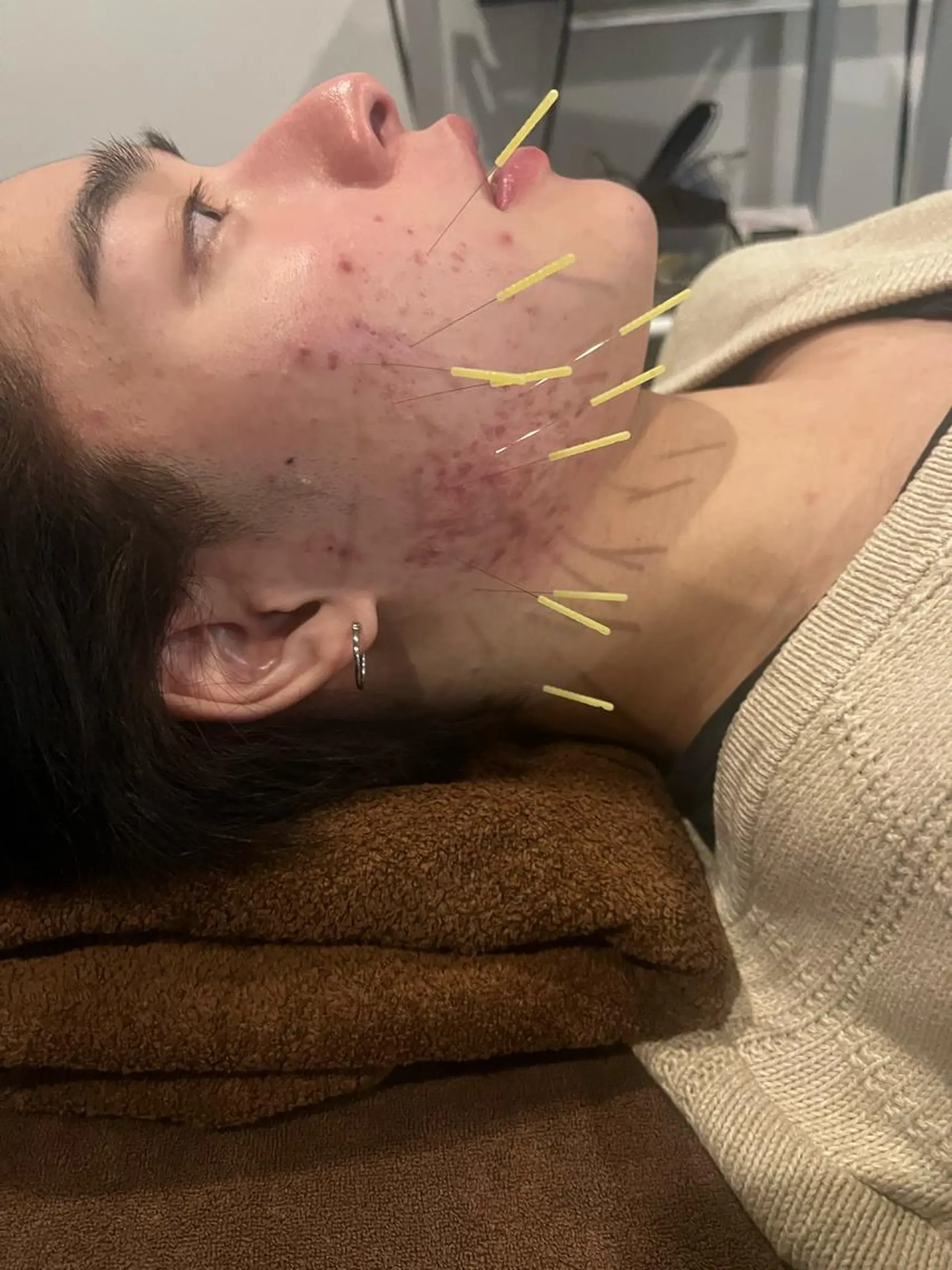 メンズ エステ リラク 美容鍼灸サロン LOMIHARIのエステ・リラクイメージ