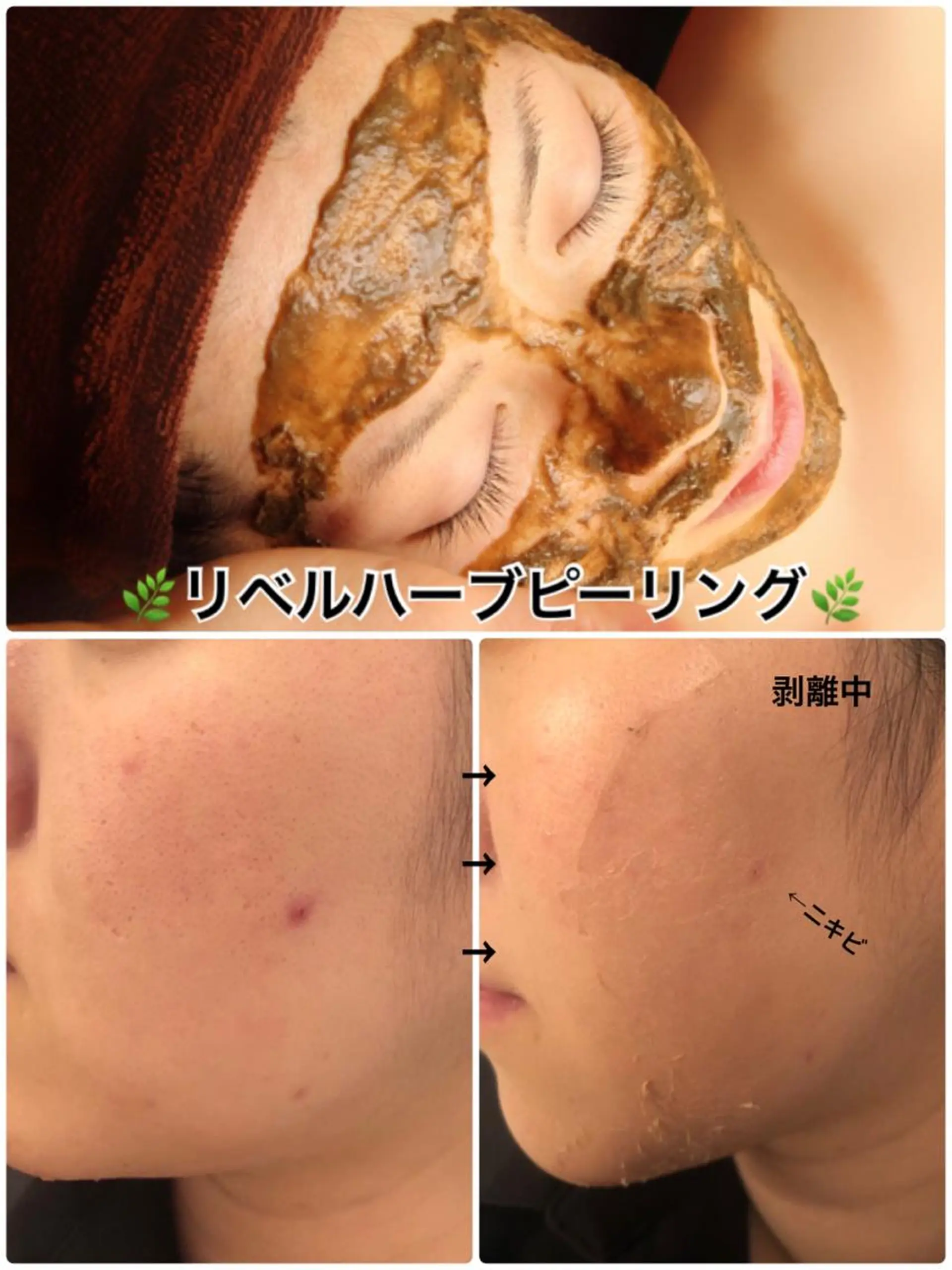 エステ 【リベルハーブピーリング認定店】敏感肌・美白脱毛専門店Dione立川店所属・Dione 立川店のエステ・リラクイメージ