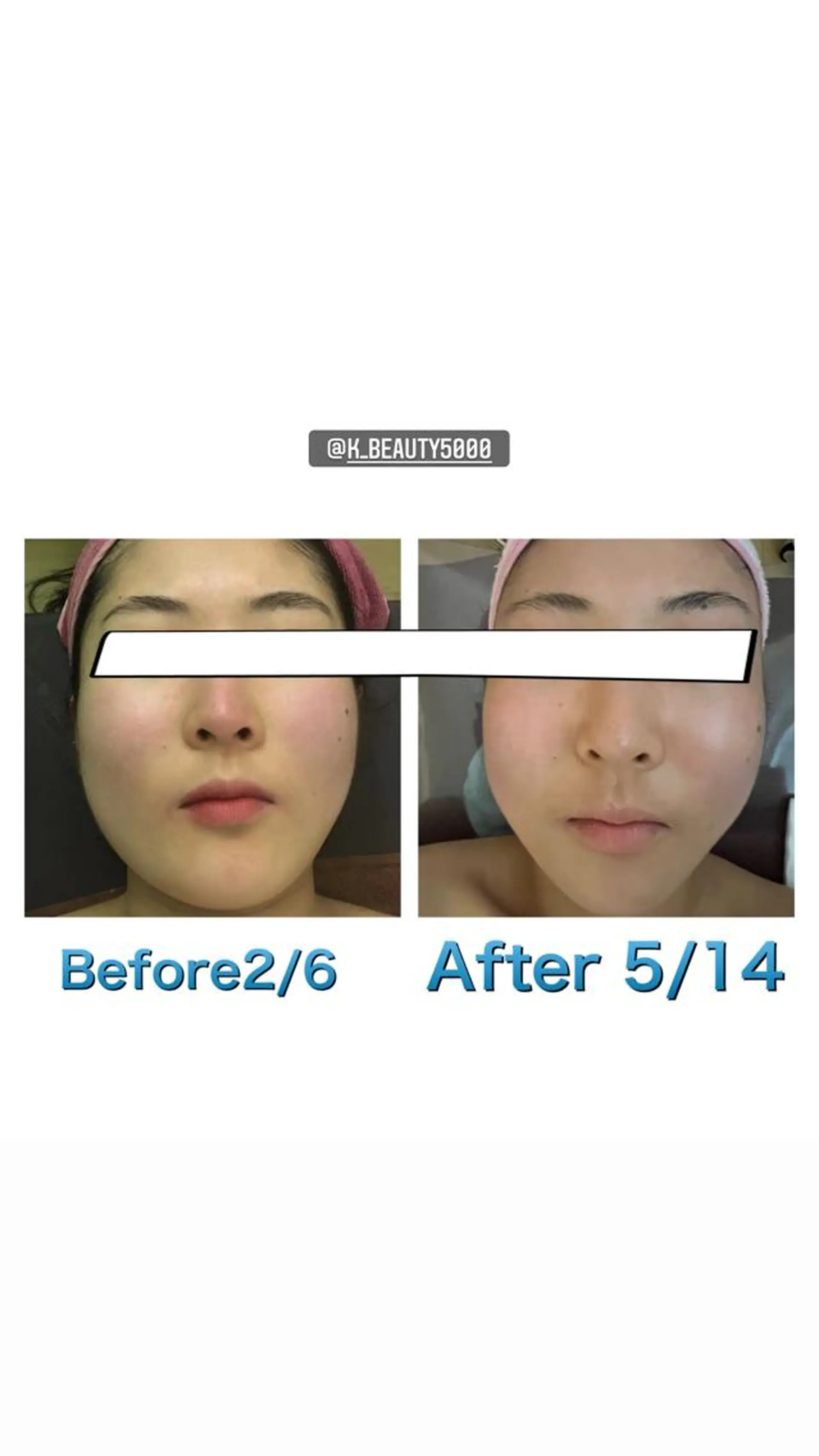 【ハイパーナイフ痩身&小顔コルギ&ハーブピーリング】K-Beauty　東新宿所属・kーbeauty痩身 フェイシャルのエステ・リラクイメージ