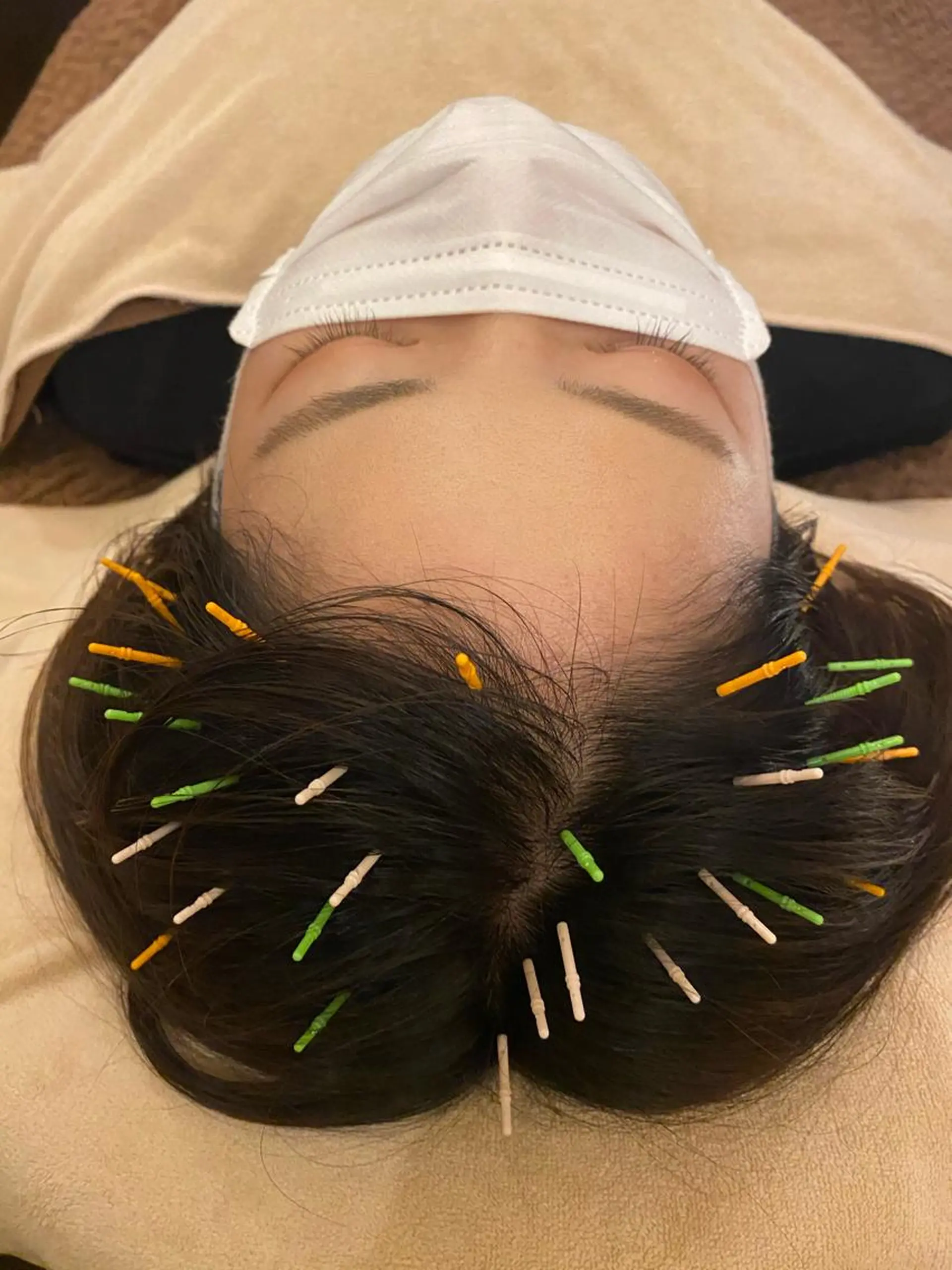 Acupuncture  salon LINOA リノア鍼灸院所属・ヘッドスパ鍼/小顔鍼 耳ツボ 　LINOAのエステ・リラクイメージ