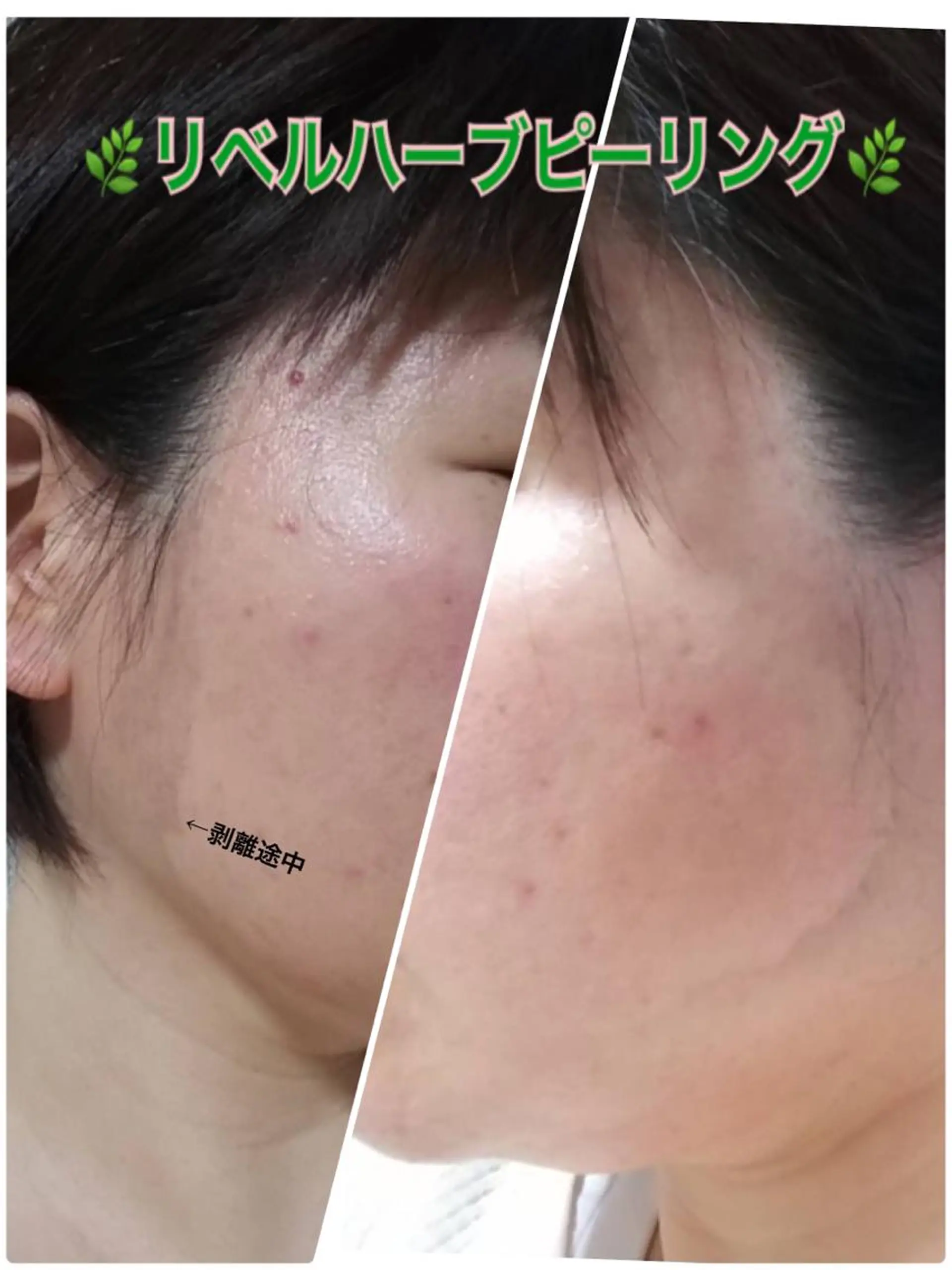 エステ 【リベルハーブピーリング認定店】敏感肌・美白脱毛専門店Dione立川店所属・Dione 立川店のエステ・リラクイメージ