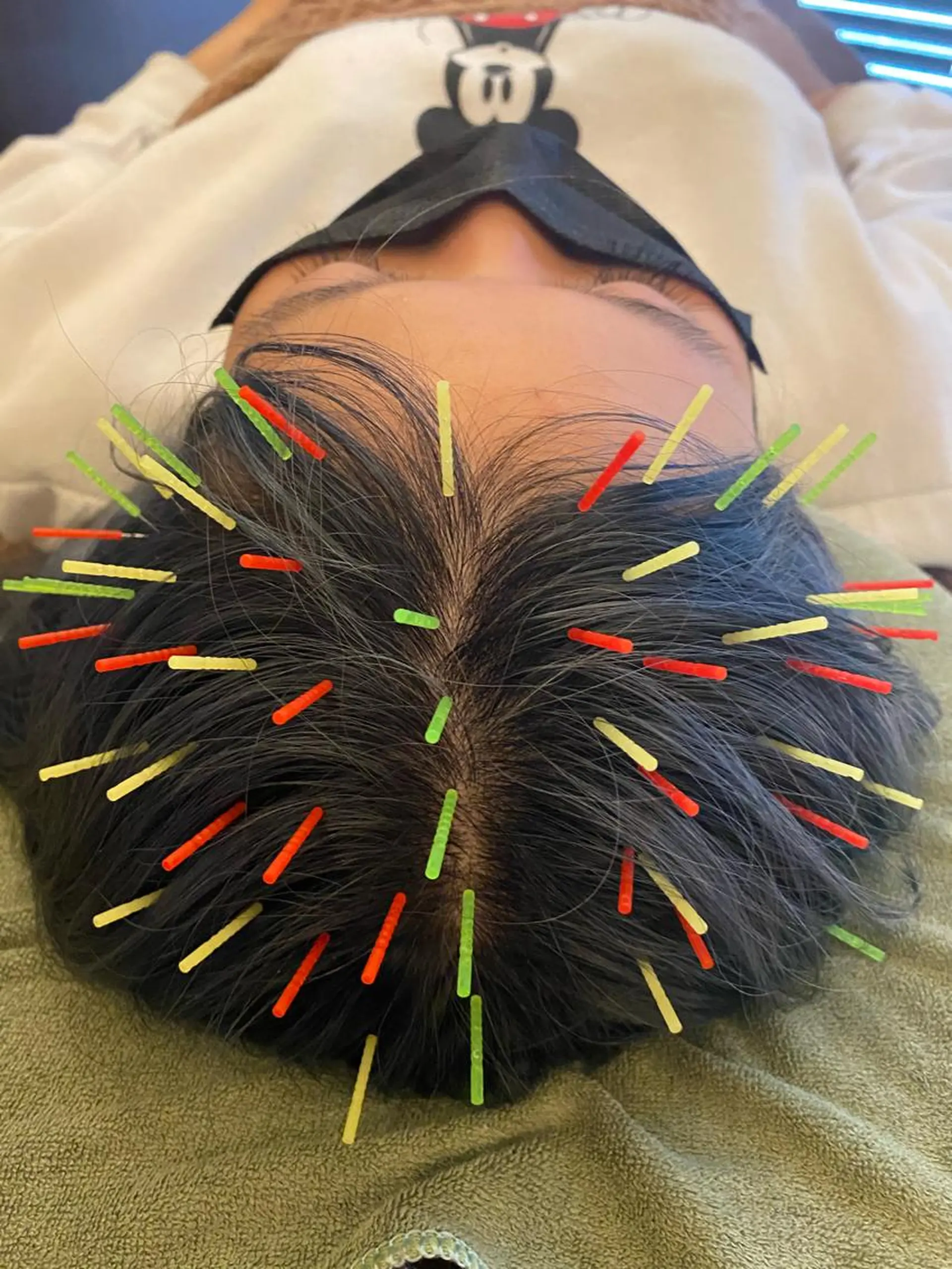 ヘッドスパ Acupuncture  salon LINOA リノア鍼灸院所属・ヘッドスパ鍼/小顔鍼 耳ツボ 　LINOAのエステ・リラクイメージ