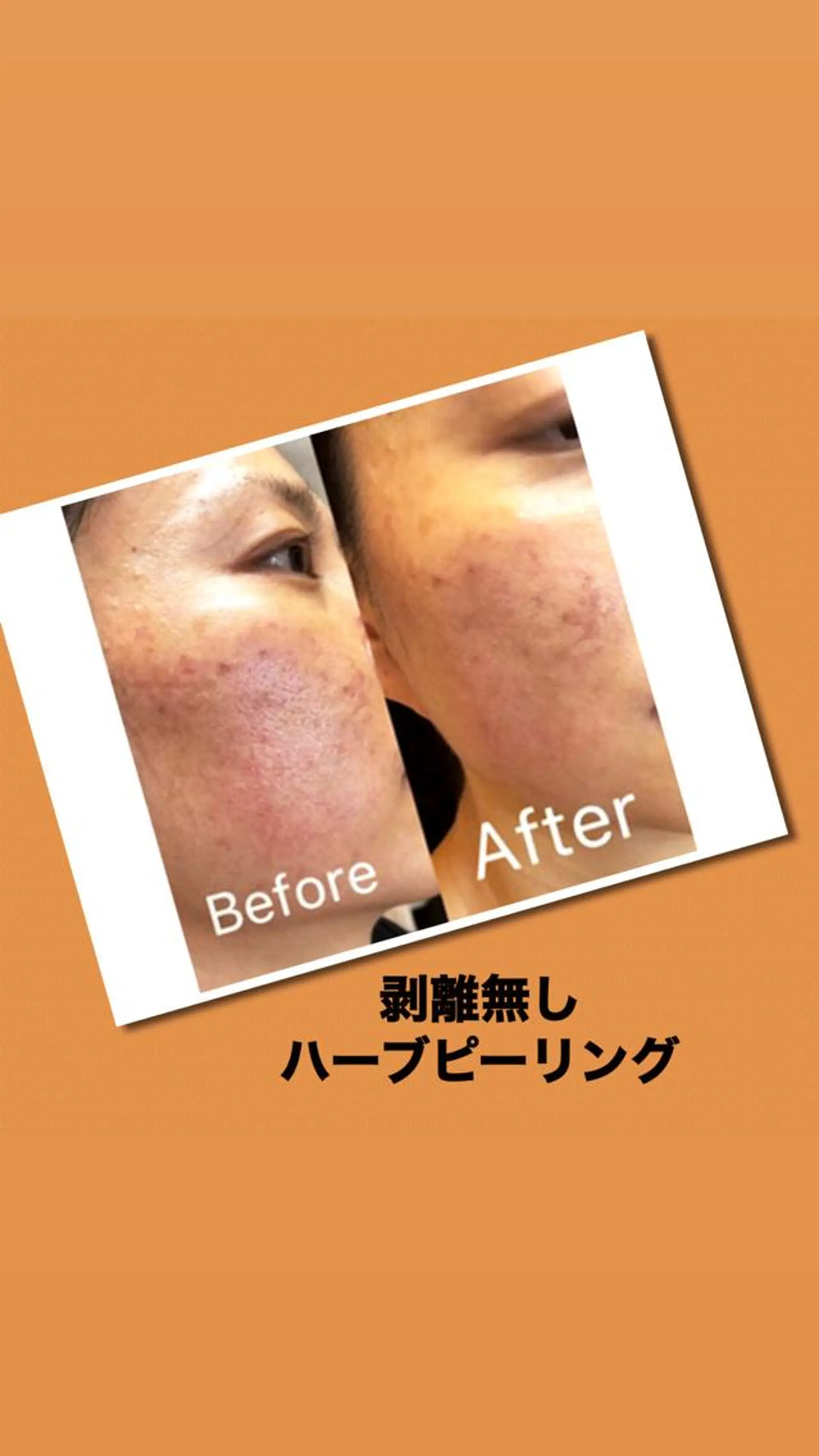 【ハイパーナイフ痩身&小顔コルギ&ハーブピーリング】K-Beauty　東新宿所属・kーbeauty痩身 フェイシャルのエステ・リラクイメージ