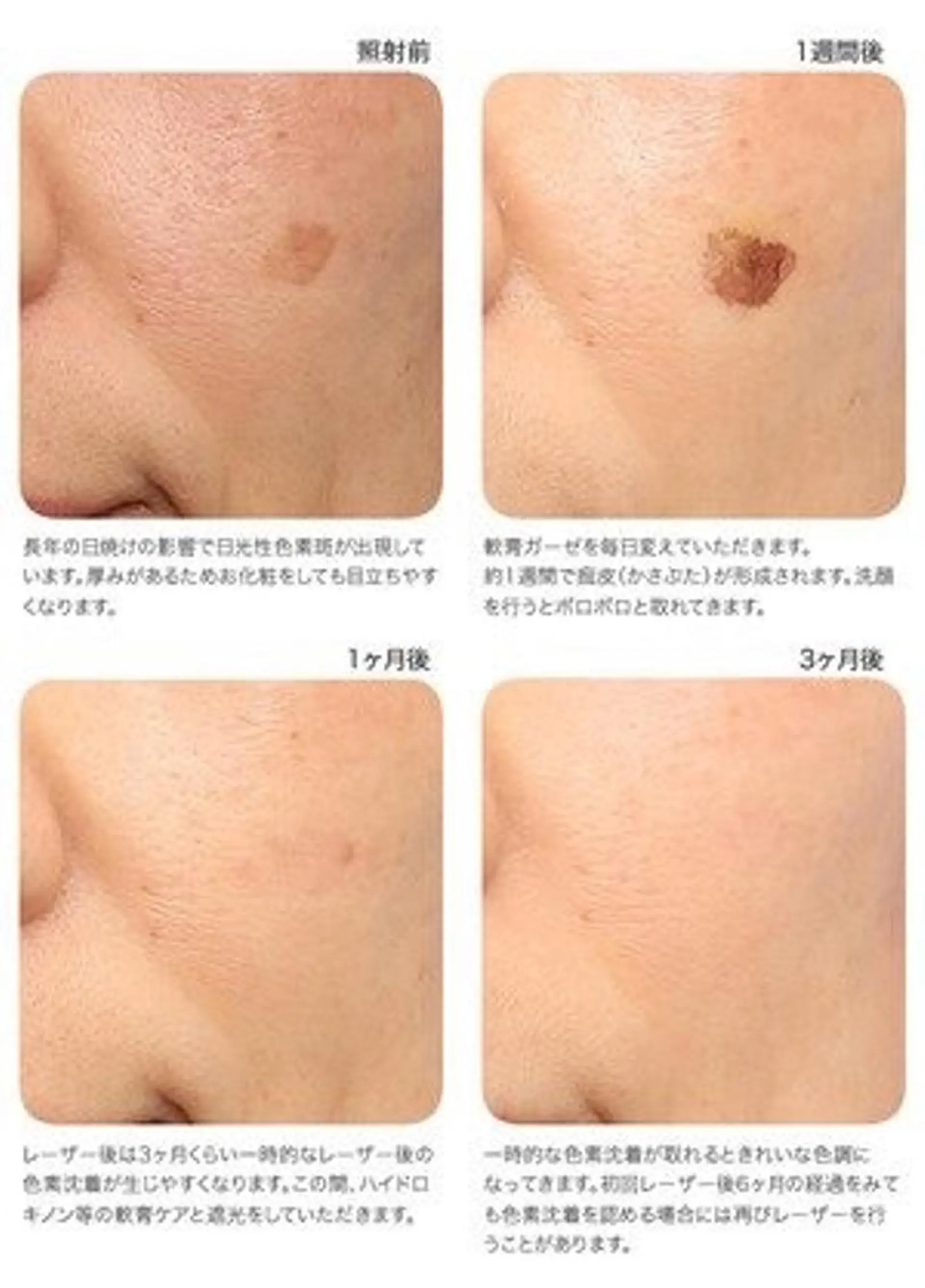 脱毛 ジョリ   ヴェール 山口のマツエク・マツパデザイン