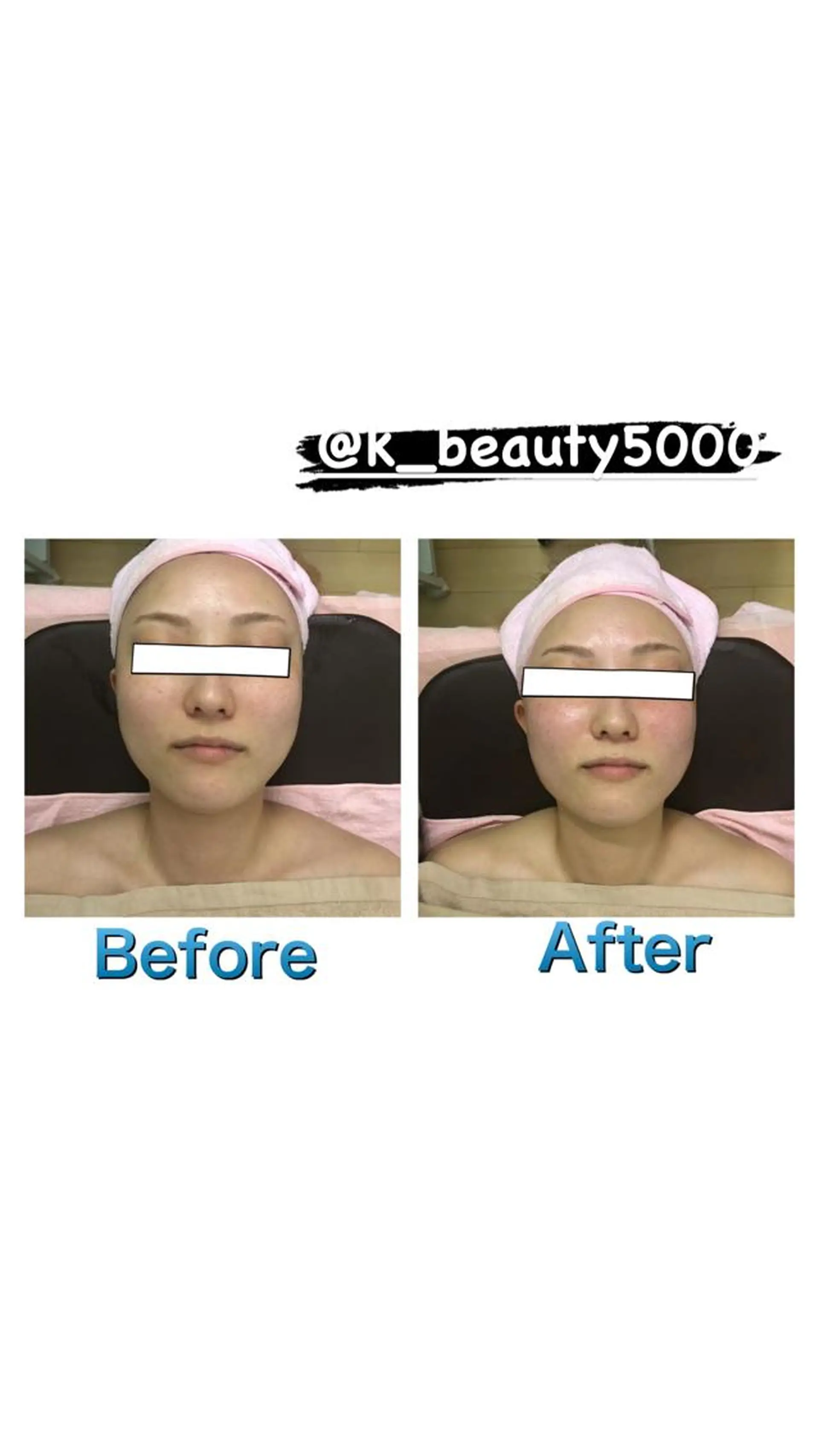 その他 【ハイパーナイフ痩身&小顔コルギ&ハーブピーリング】K-Beauty　東新宿所属・kーbeauty小顔 コルギ&インディバのエステ・リラクイメージ
