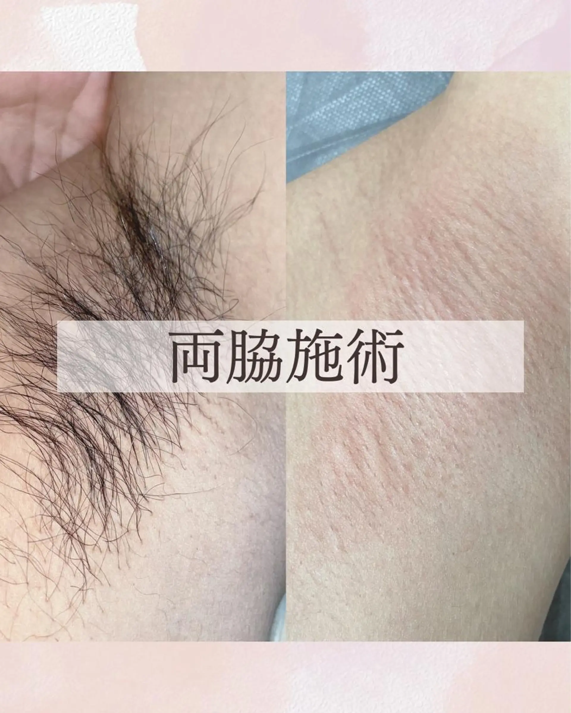 脱毛 Sugaring Hani Laniのエステ・リラクイメージ