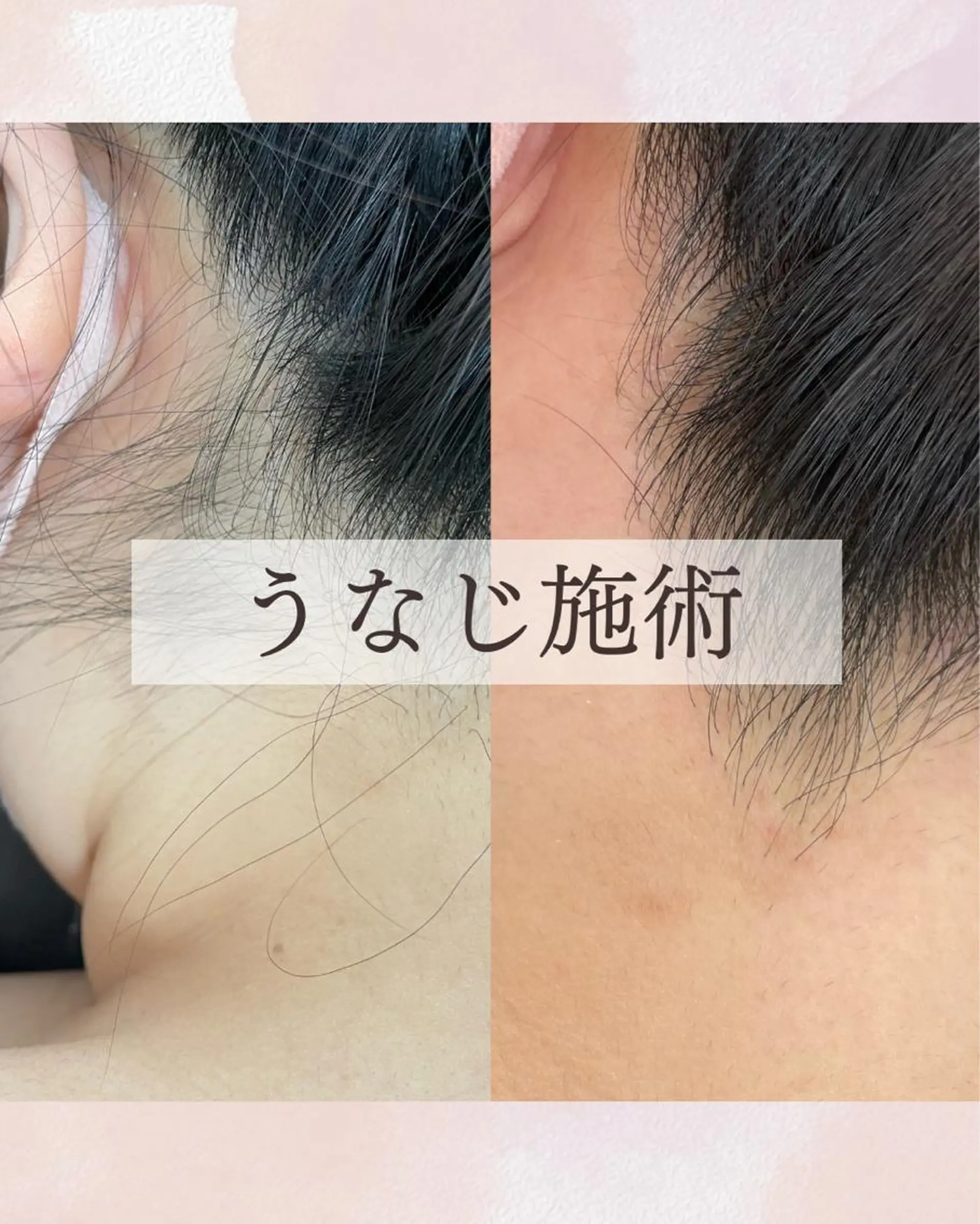 脱毛 Sugaring Hani Laniのエステ・リラクイメージ