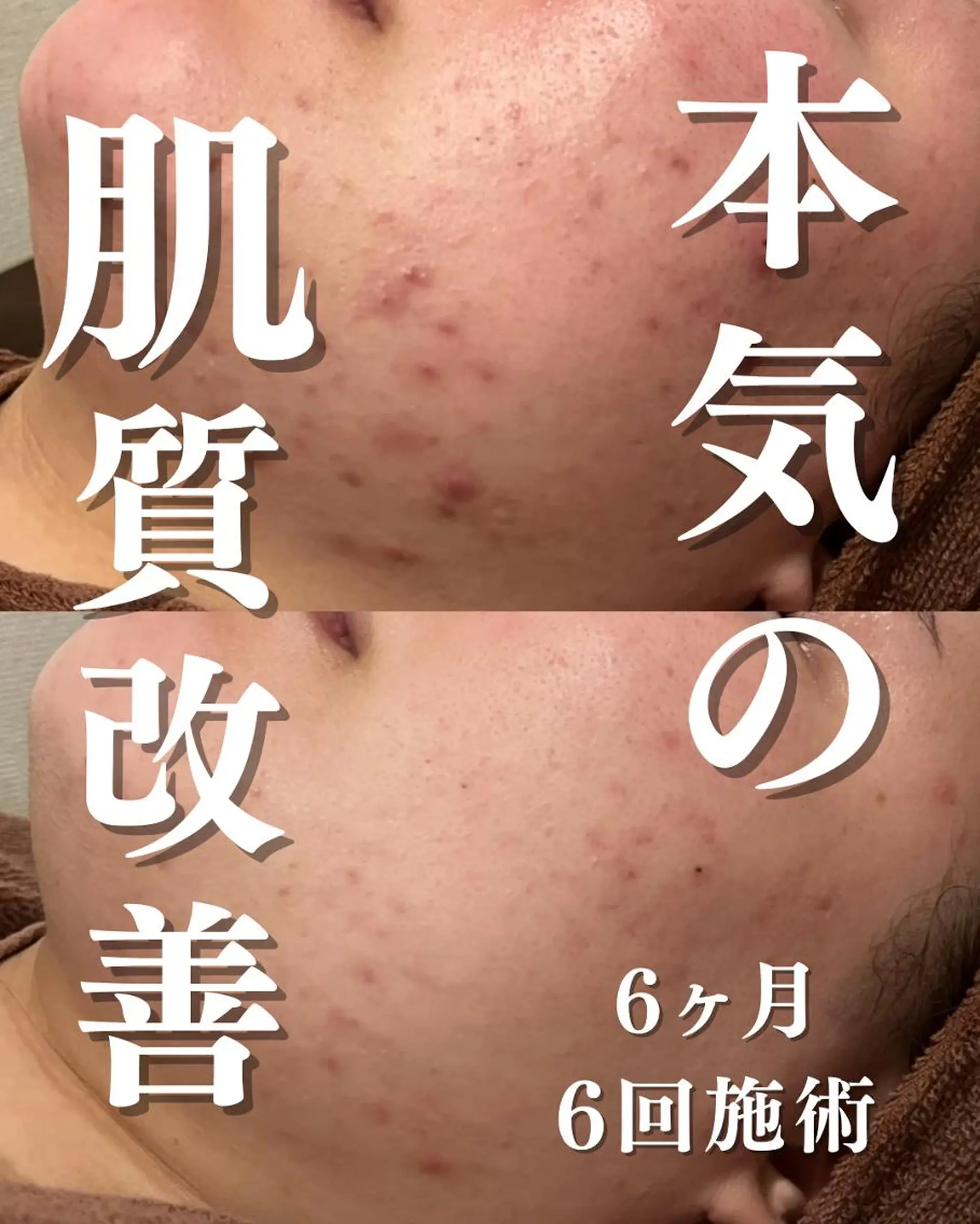 撲滅🔥 最短ニキビ改善のエステ・リラクイメージ