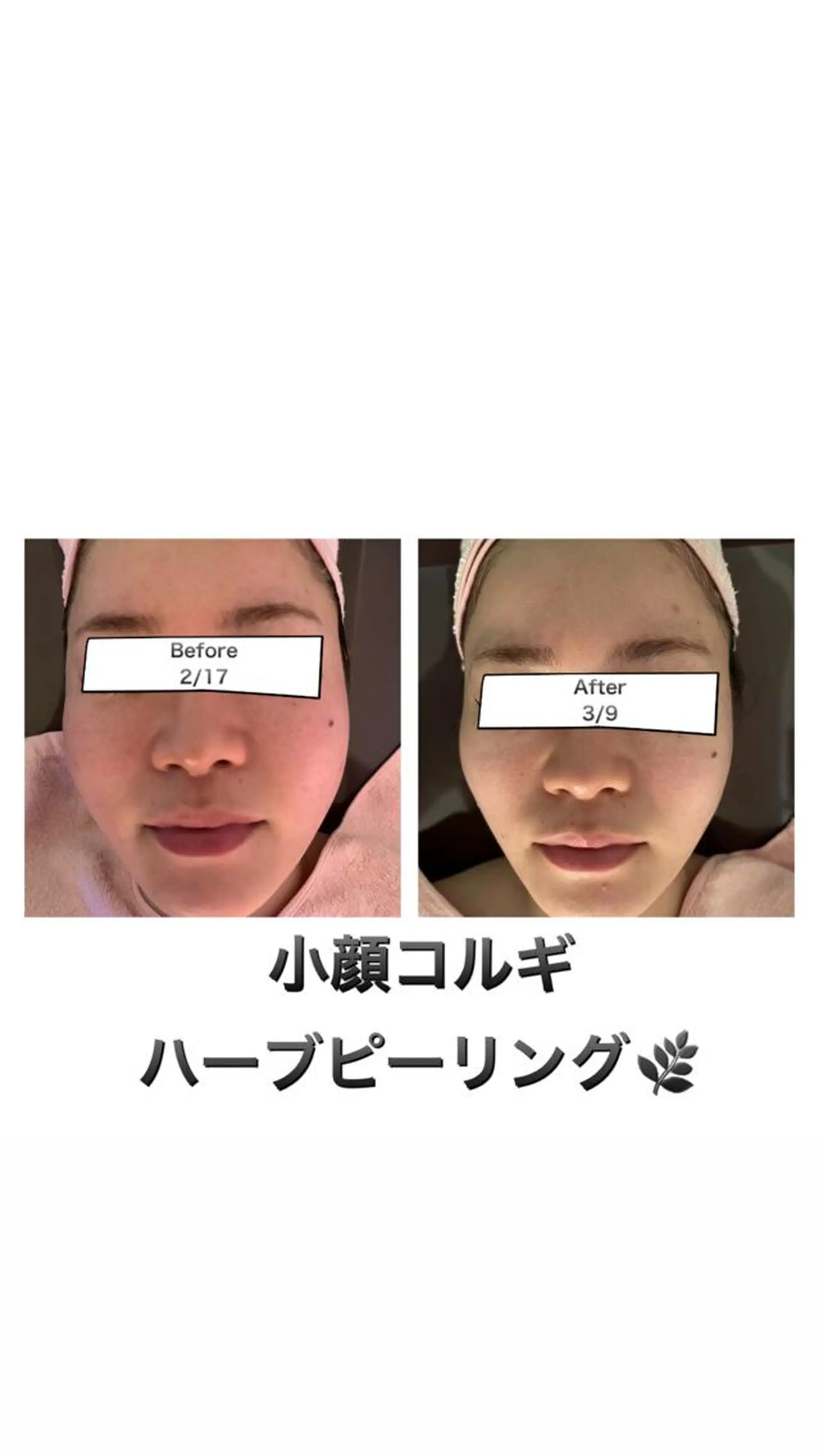 【ハイパーナイフ痩身&小顔コルギ&ハーブピーリング】K-Beauty　東新宿所属・kーbeauty小顔 コルギ&インディバのエステ・リラクイメージ