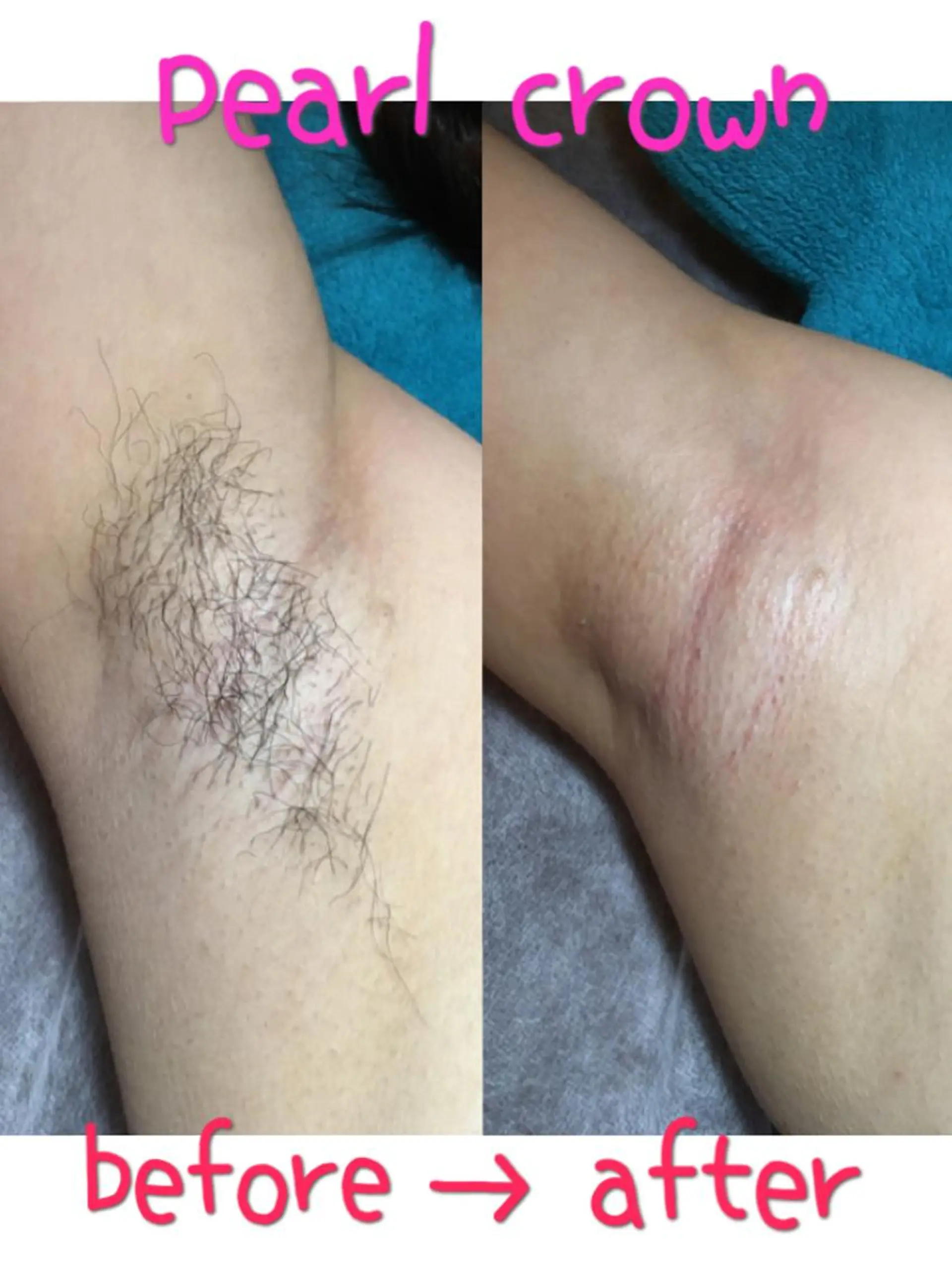 脱毛 pearl crown所属・pearlcrown 博多Wax＆光脱毛のその他イメージ