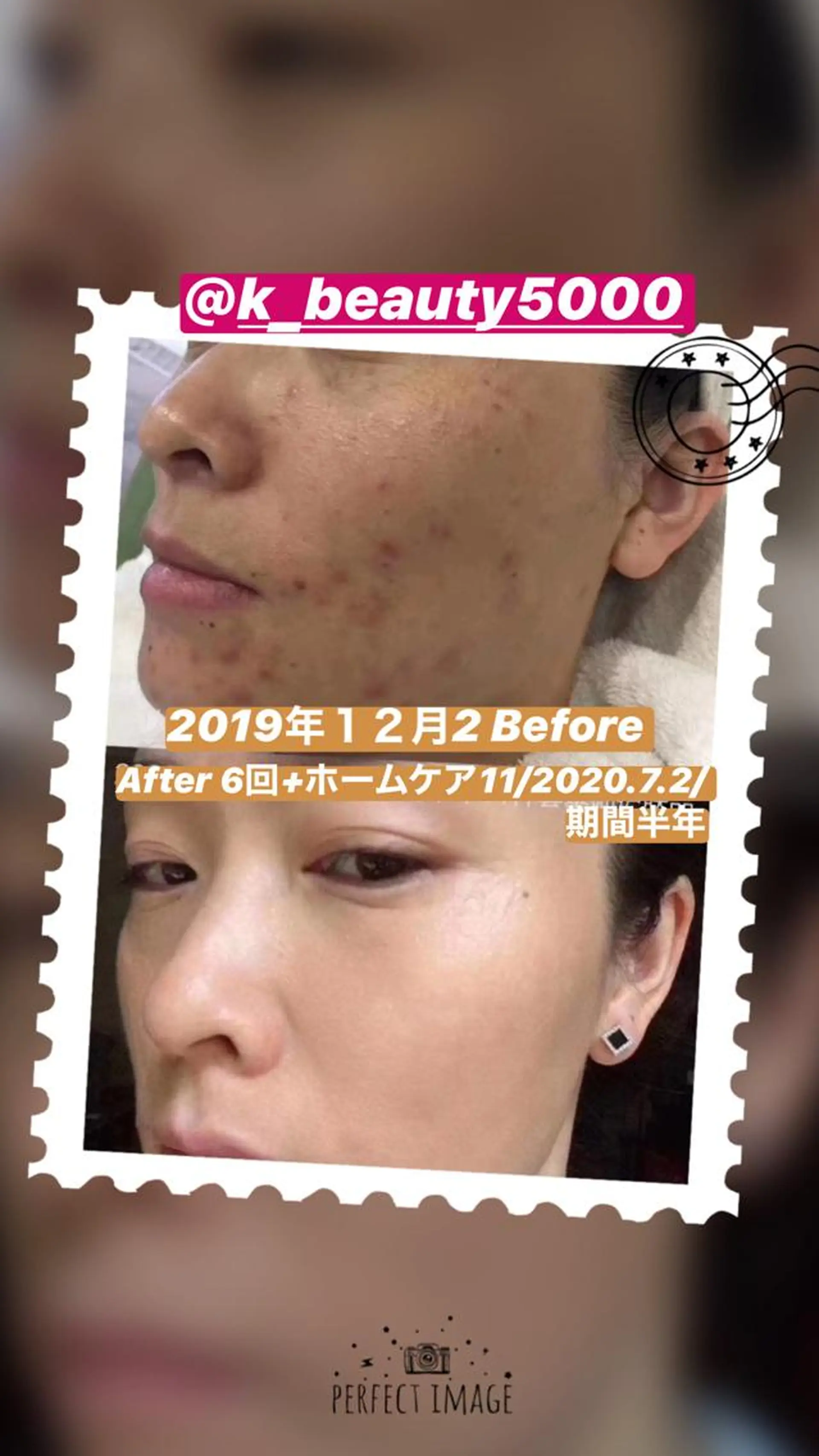 【ハイパーナイフ痩身&小顔コルギ&ハーブピーリング】K-Beauty　東新宿所属・kーbeauty痩身 フェイシャルのエステ・リラクイメージ