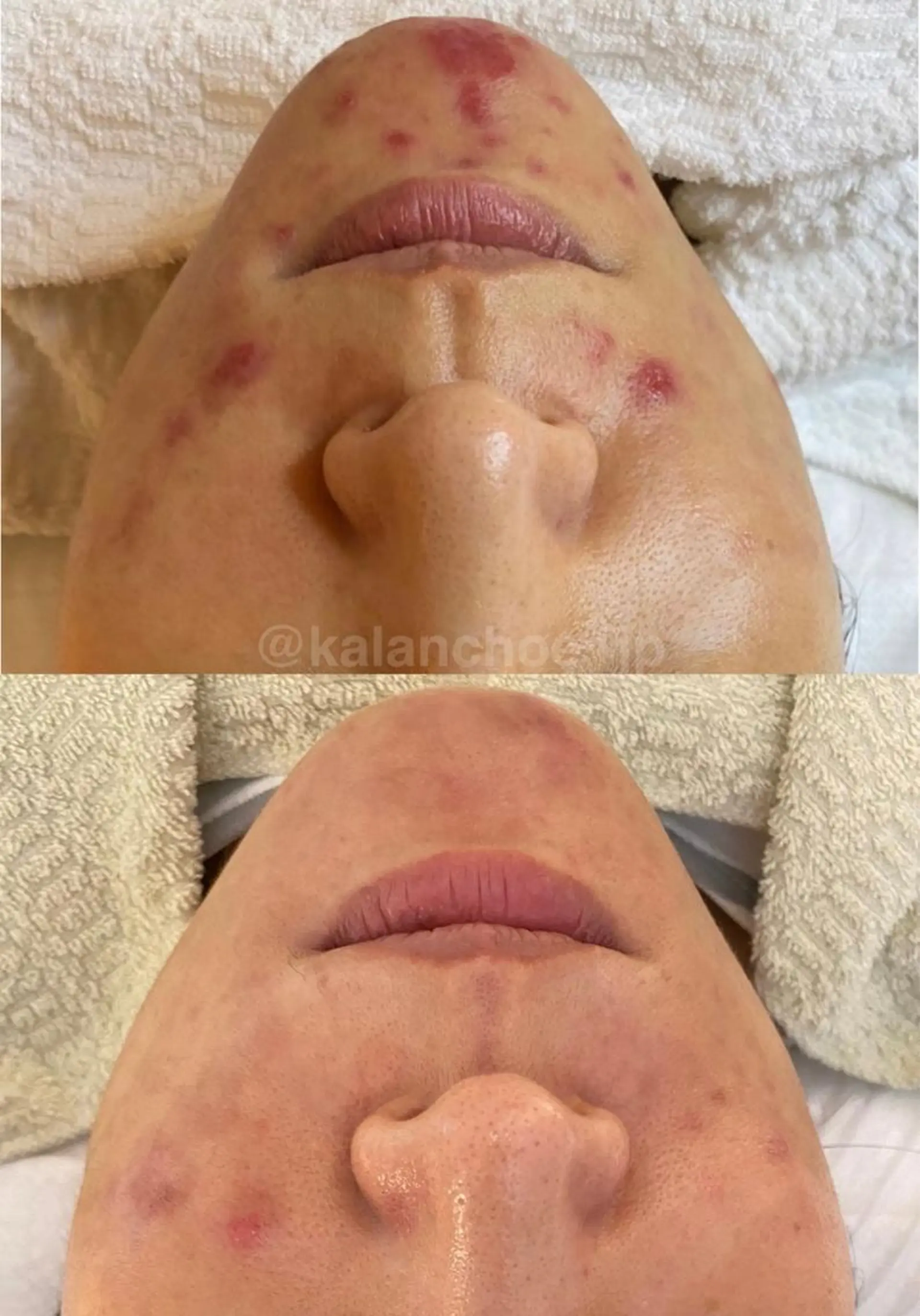 エステ 肌質改善 KALANCHOEのエステ・リラクイメージ