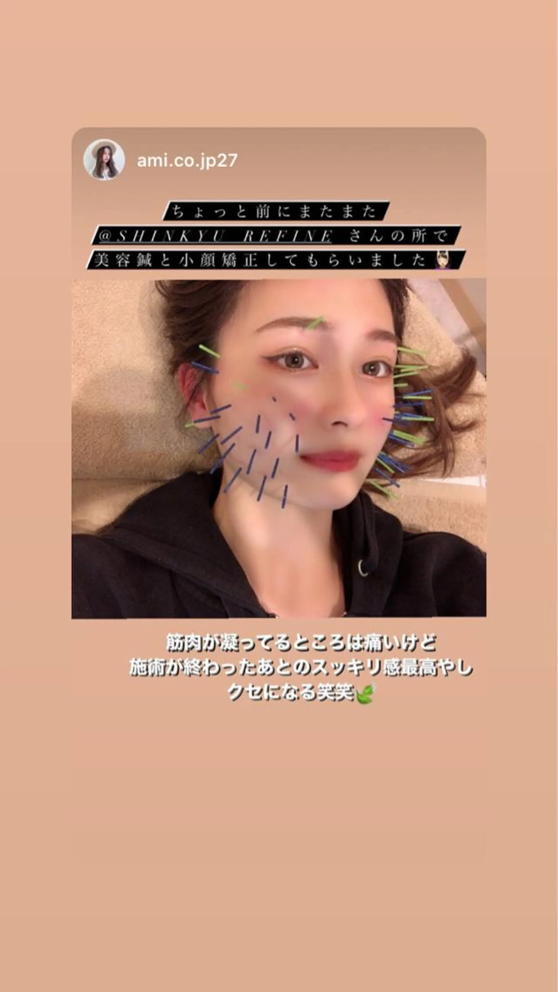 鍼灸整骨院Refine所属・鍼灸 Refineのその他イメージ