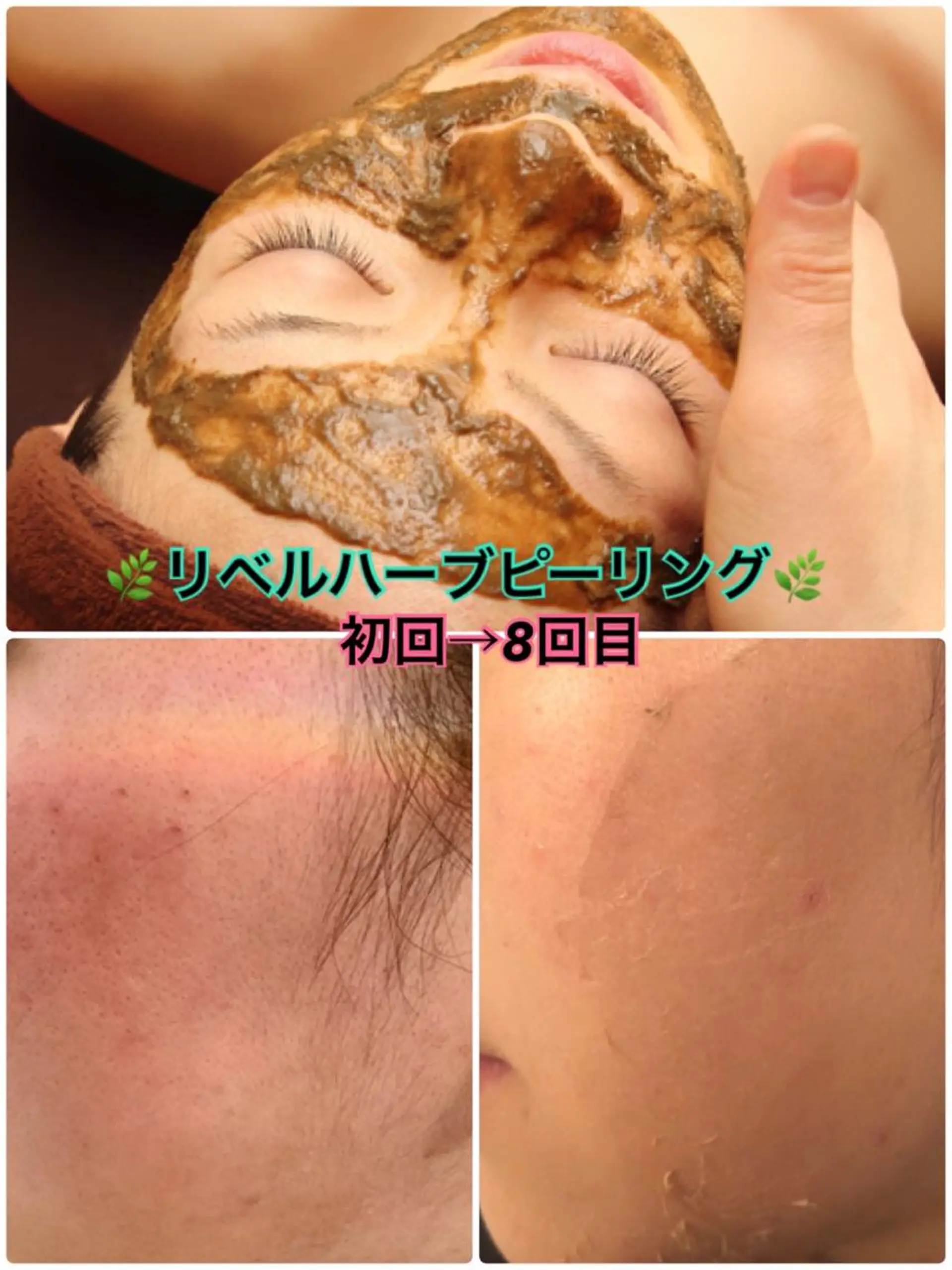 エステ 【リベルハーブピーリング認定店】敏感肌・美白脱毛専門店Dione立川店所属・Dione 立川店のエステ・リラクイメージ