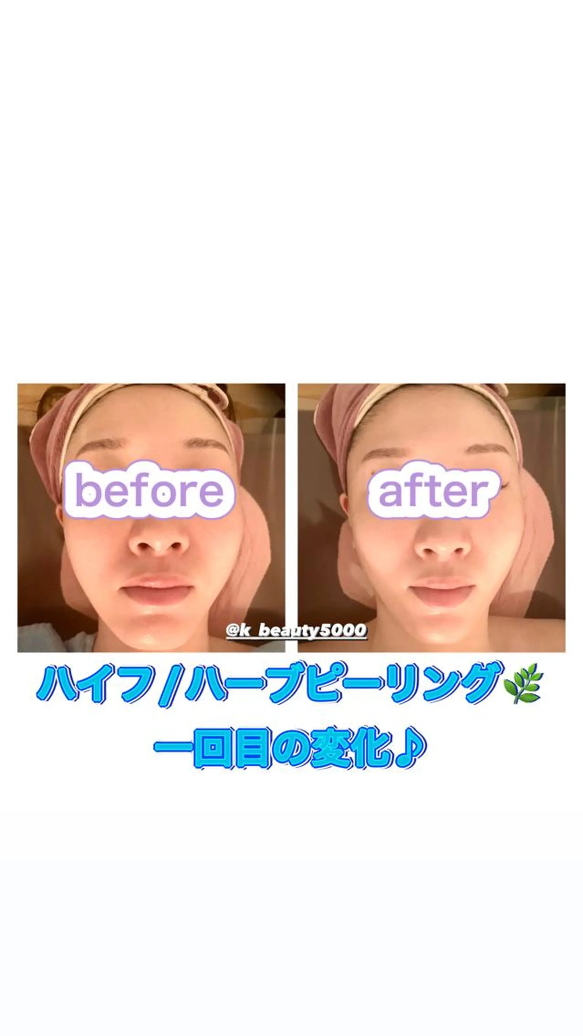 【ハイパーナイフ痩身&小顔コルギ&ハーブピーリング】K-Beauty　東新宿所属・kーbeauty小顔 コルギ&インディバのエステ・リラクイメージ