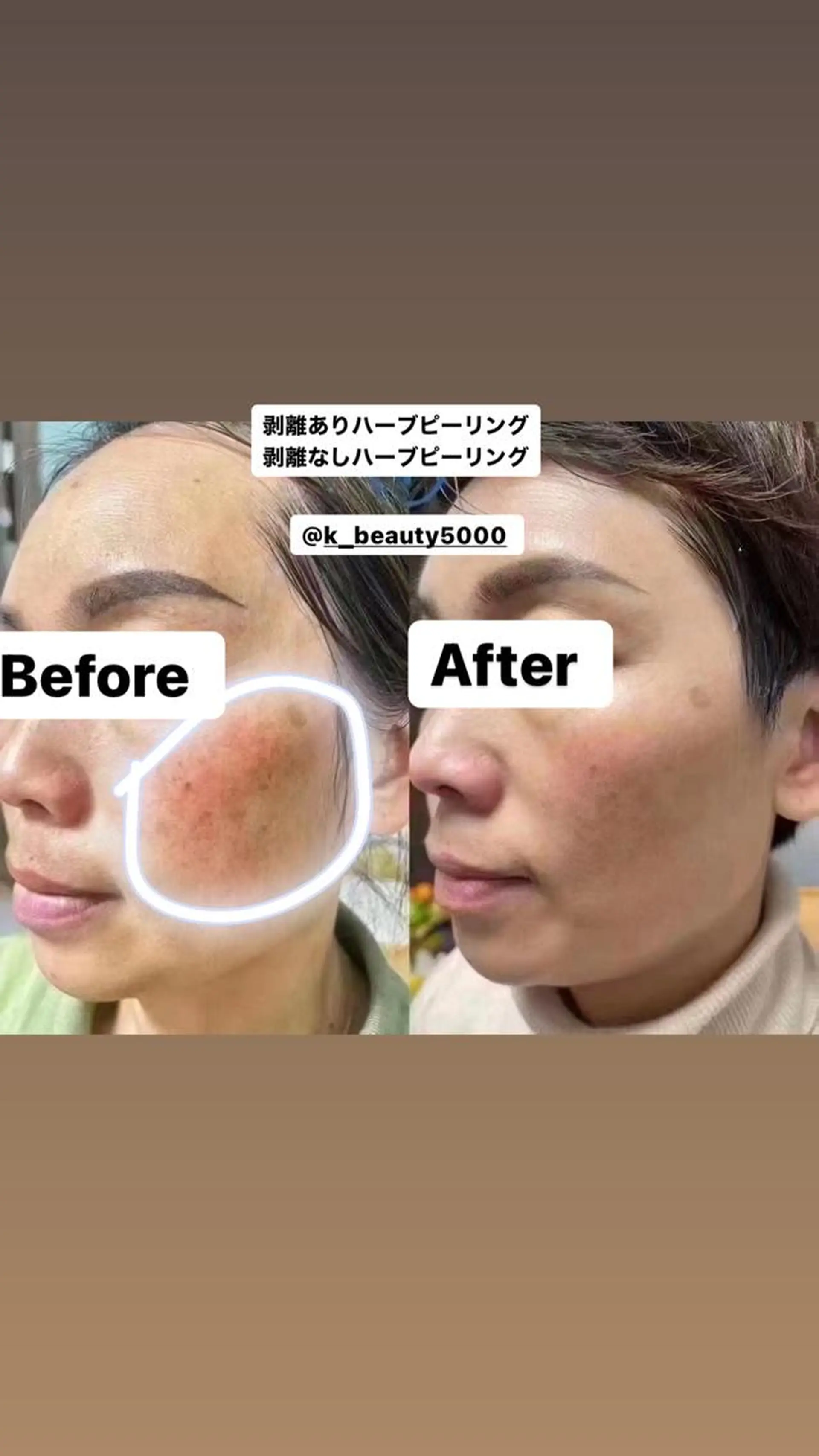 【ハイパーナイフ痩身&小顔コルギ&ハーブピーリング】K-Beauty　東新宿所属・kーbeauty小顔 コルギ&インディバのエステ・リラクイメージ