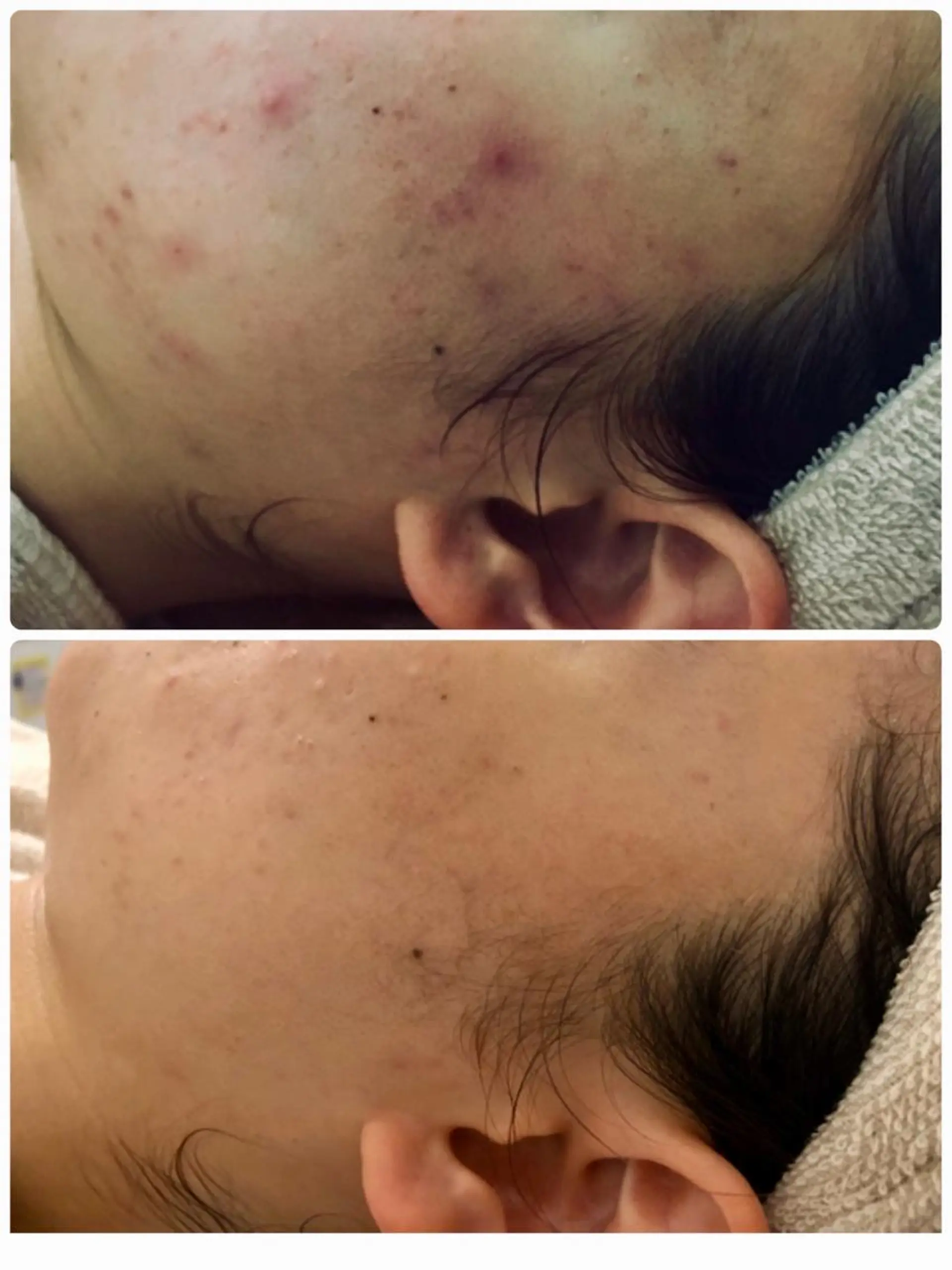 Meupニキビ専門店 背中/ハーブ/ララのその他イメージ