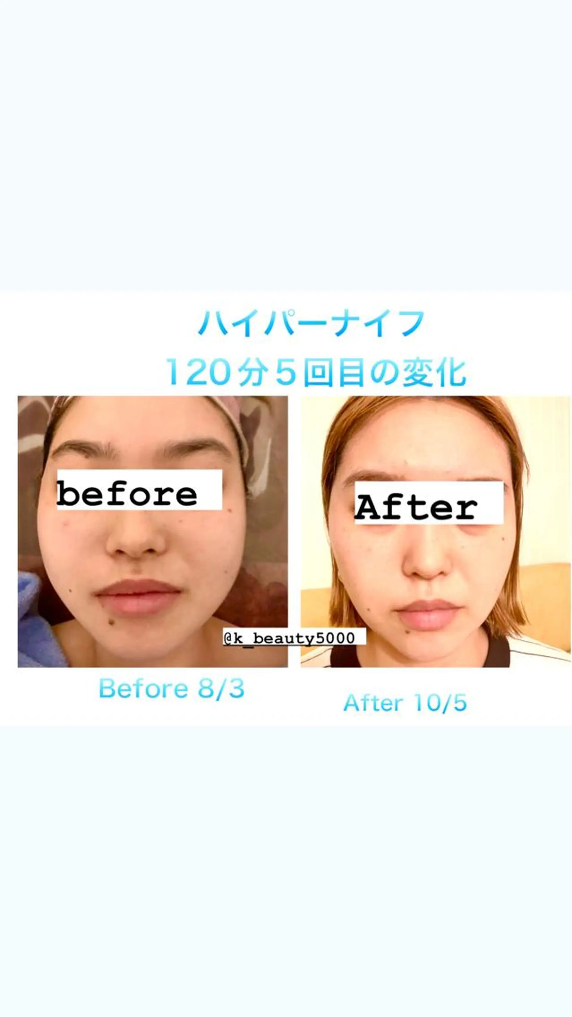 【ハイパーナイフ痩身&小顔コルギ&ハーブピーリング】K-Beauty　東新宿所属・kーbeauty小顔 コルギ&インディバのエステ・リラクイメージ