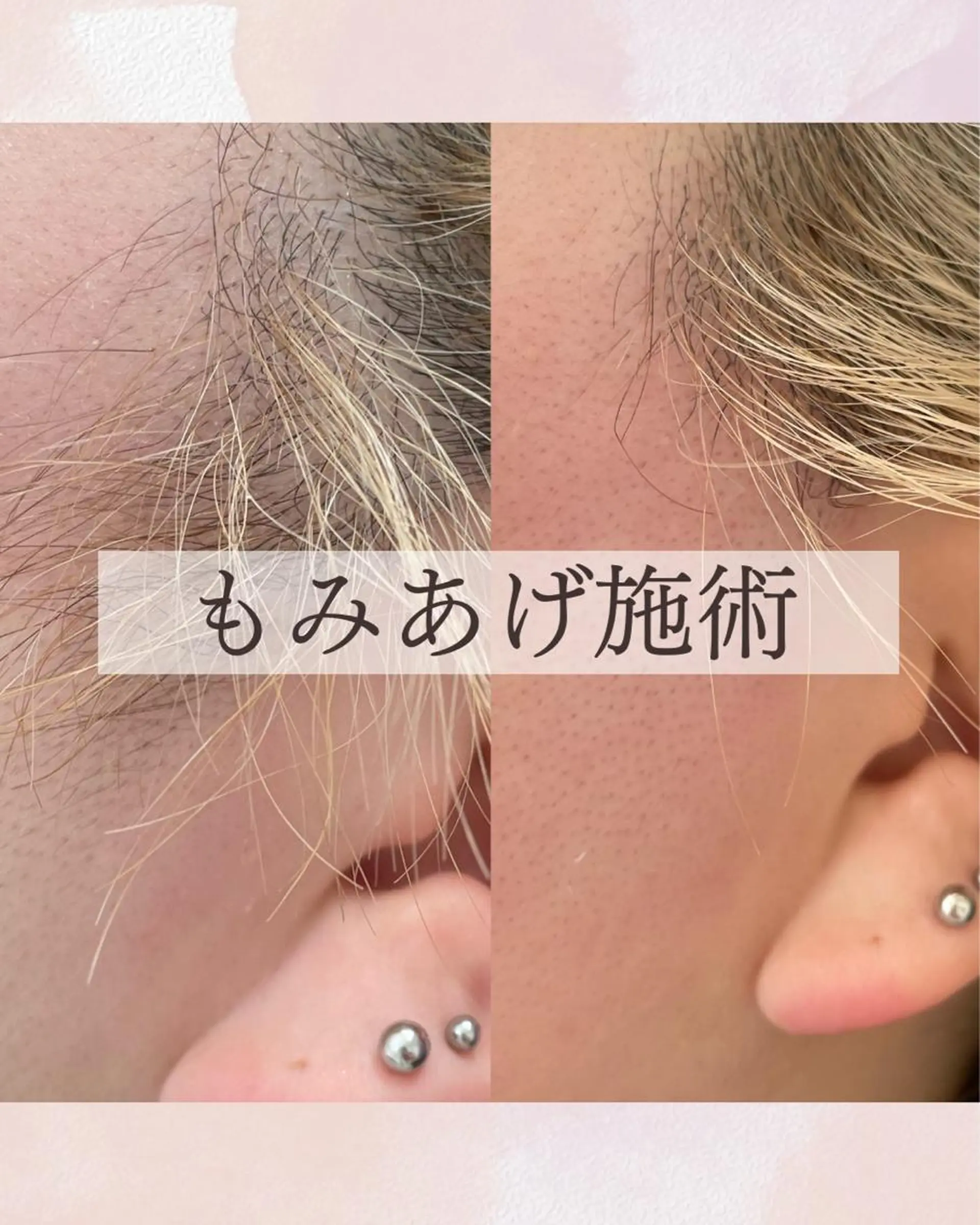脱毛 Sugaring Hani Laniのエステ・リラクイメージ