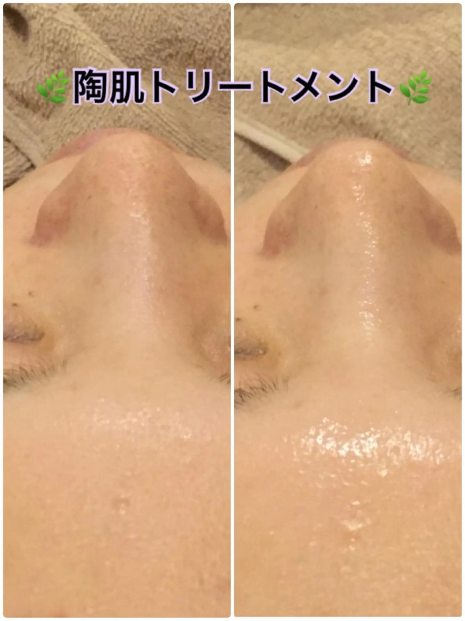 エステ 【リベルハーブピーリング認定店】敏感肌・美白脱毛専門店Dione立川店所属・Dione 立川店のエステ・リラクイメージ