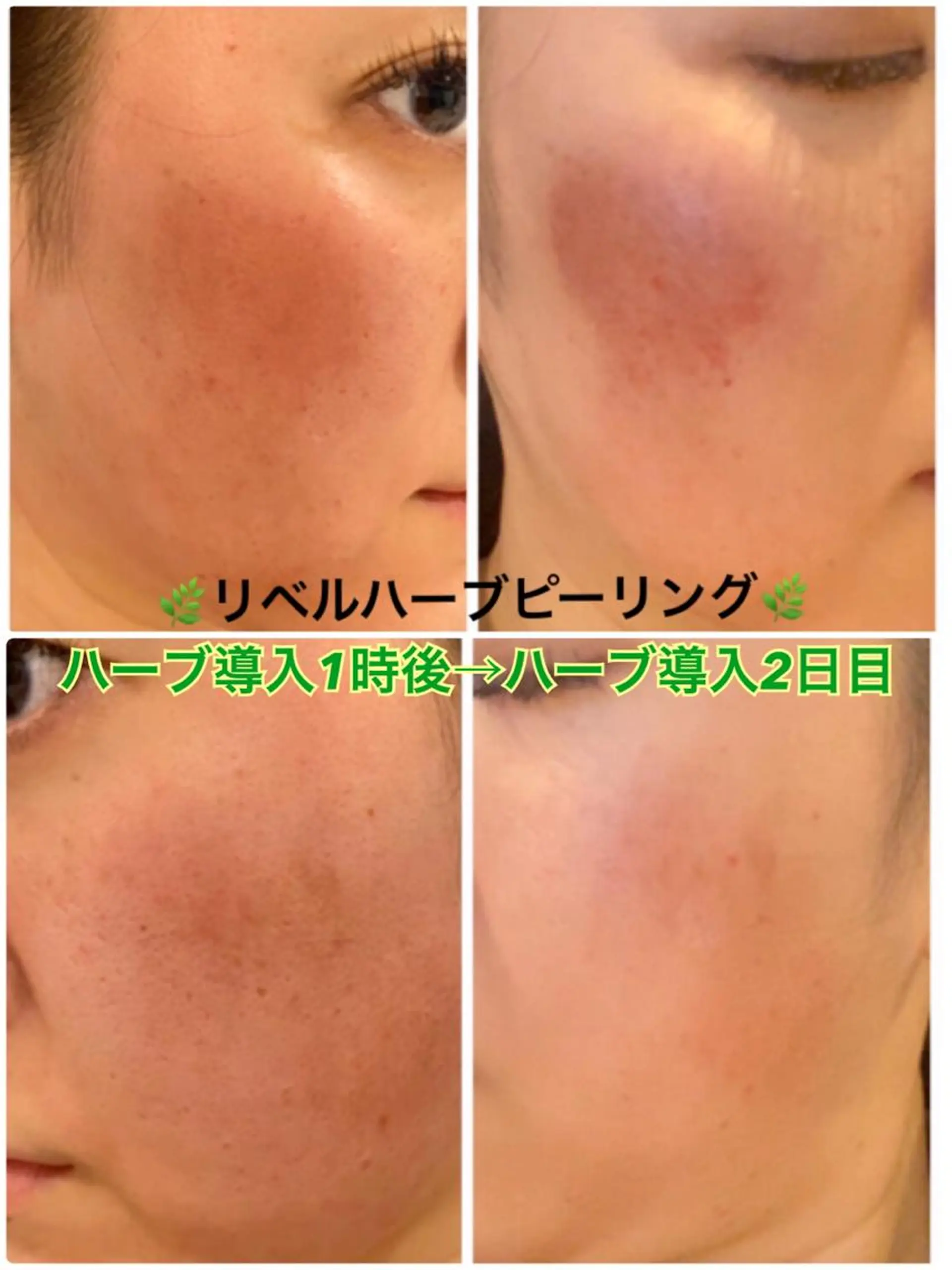 エステ 【リベルハーブピーリング認定店】敏感肌・美白脱毛専門店Dione立川店所属・Dione 立川店のエステ・リラクイメージ