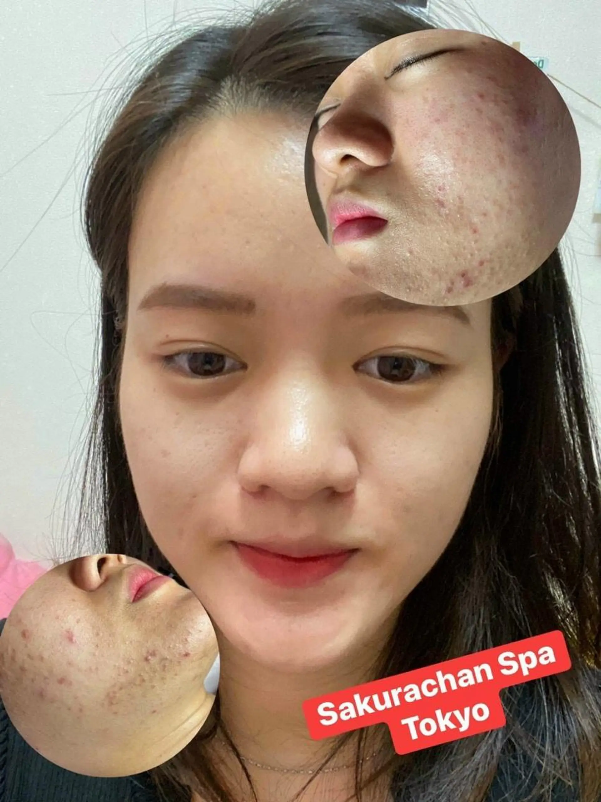 ニキビ、痩身、脱毛、 サクラチャンスパのエステ・リラクイメージ