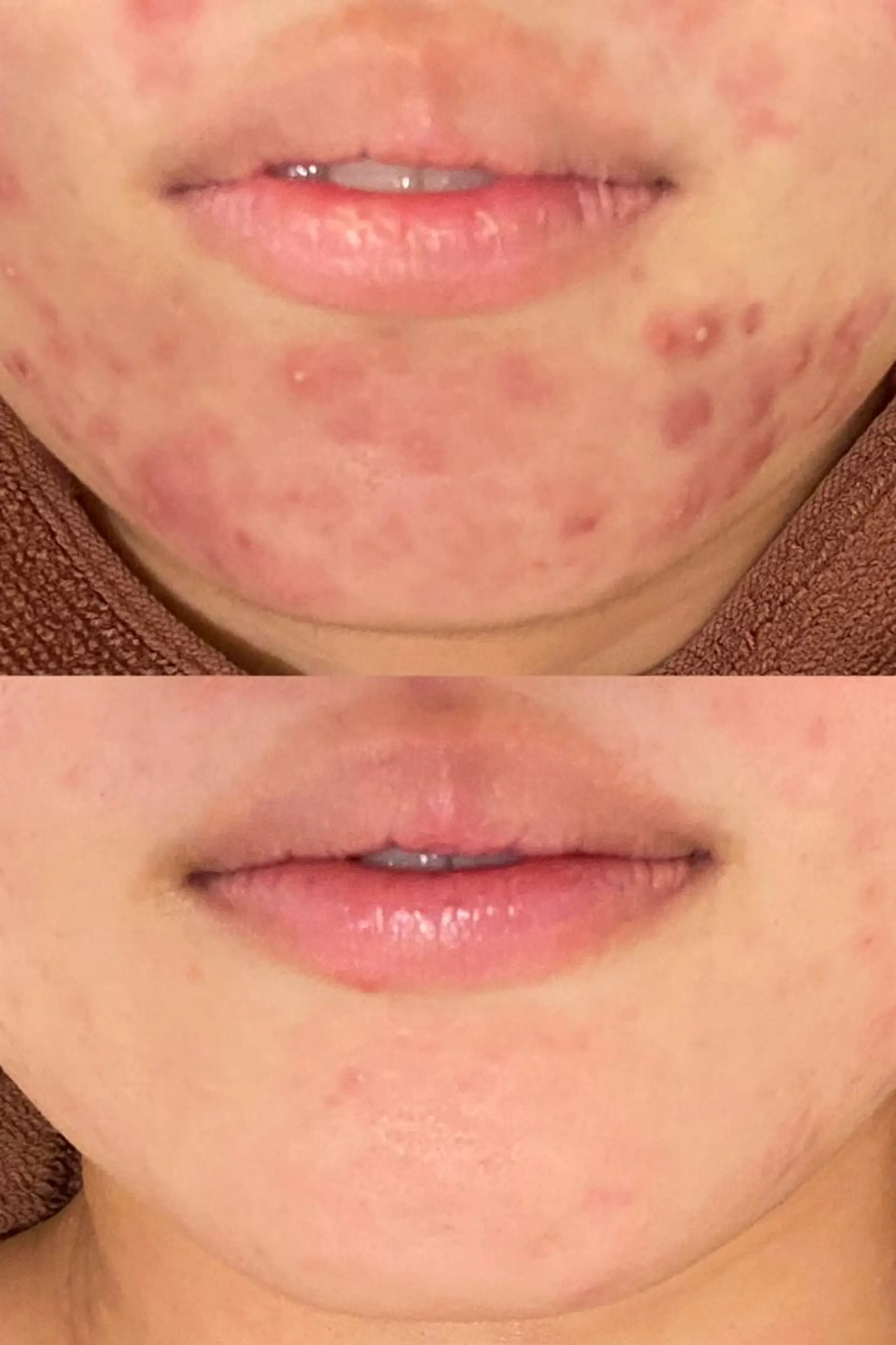 エステ リラク ニキビ跡改善専門🔥 医療にはできない改善のエステ・リラクイメージ