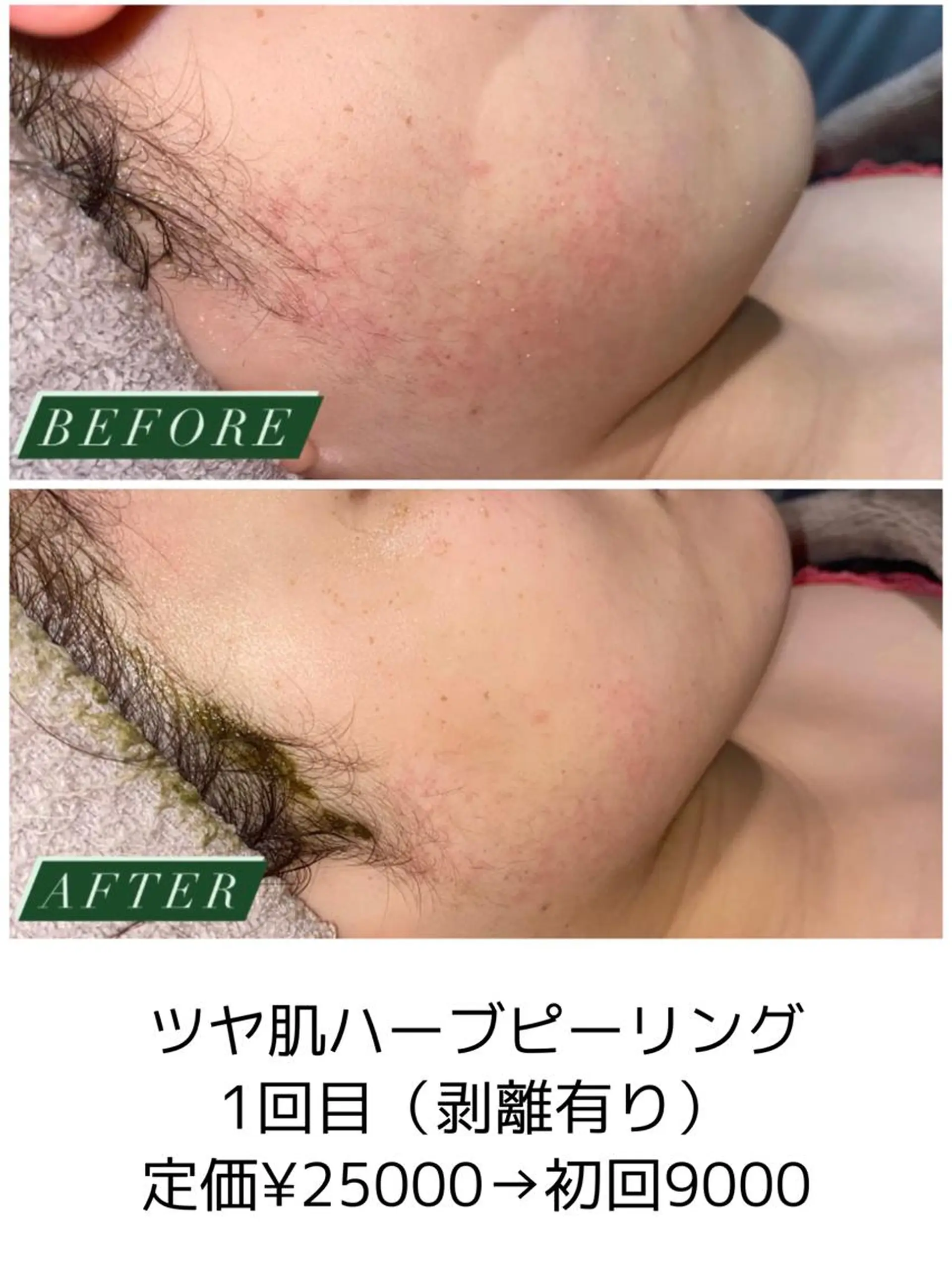 エステ ハーブピーリング・毛穴ケア専門サロンSalon de LENA所属・ハーブピーリング 専門店/名古屋駅前店のエステ・リラクイメージ