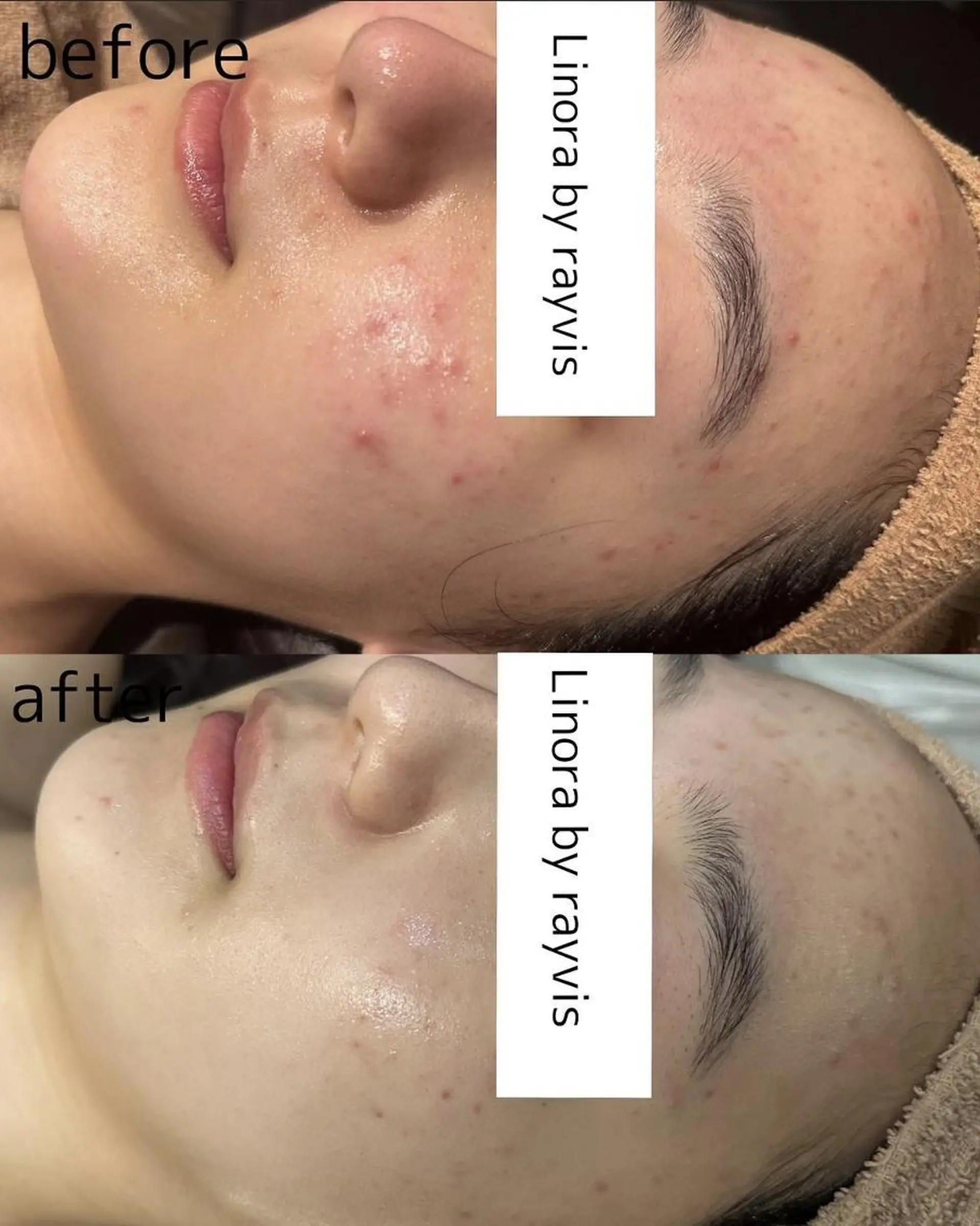 脱毛 👑Linolaby RAYVIS👑⭐️のエステ・リラクイメージ