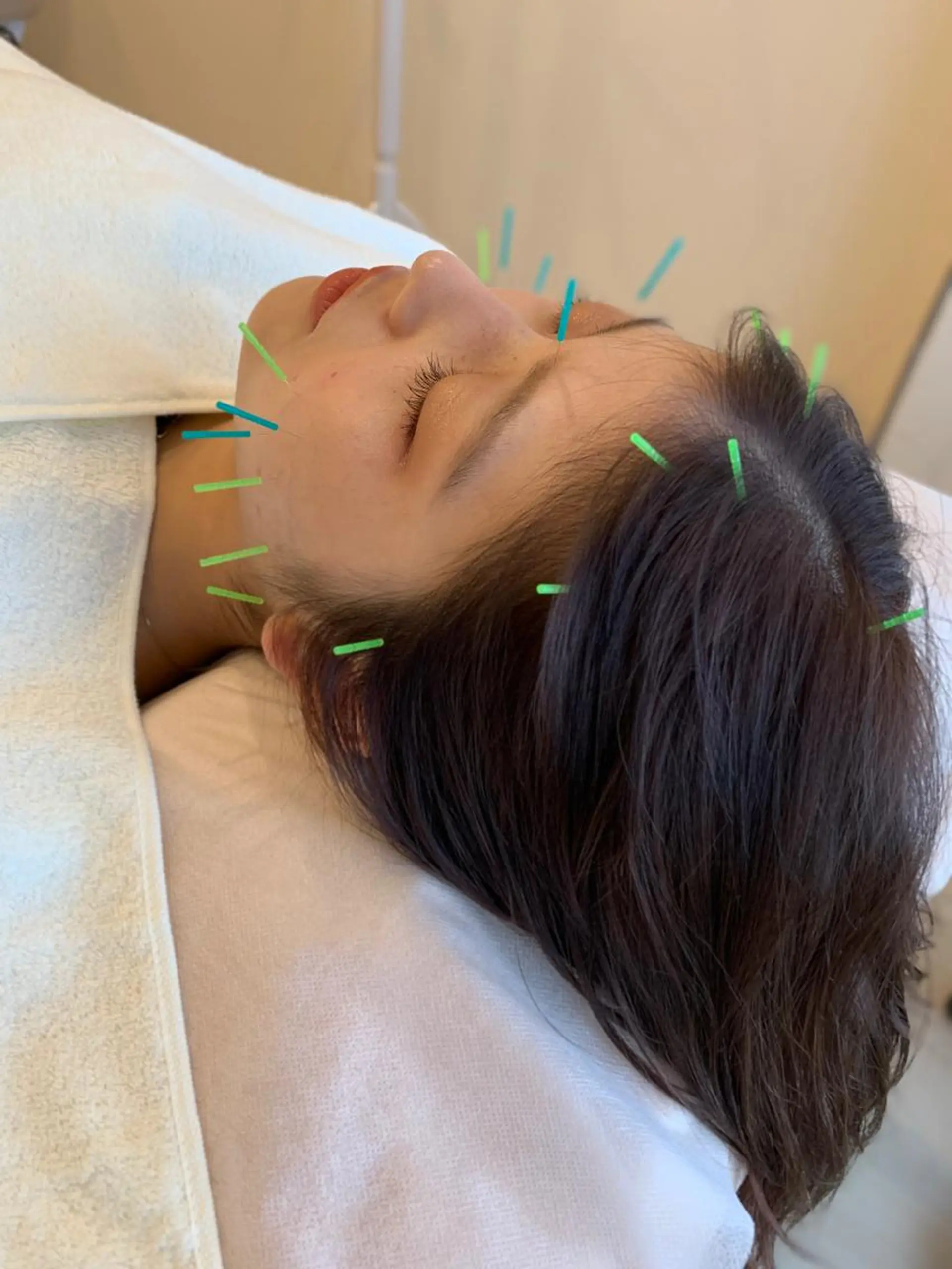 新宿hari-me所属・美容鍼hari-me 新宿のエステ・リラクイメージ