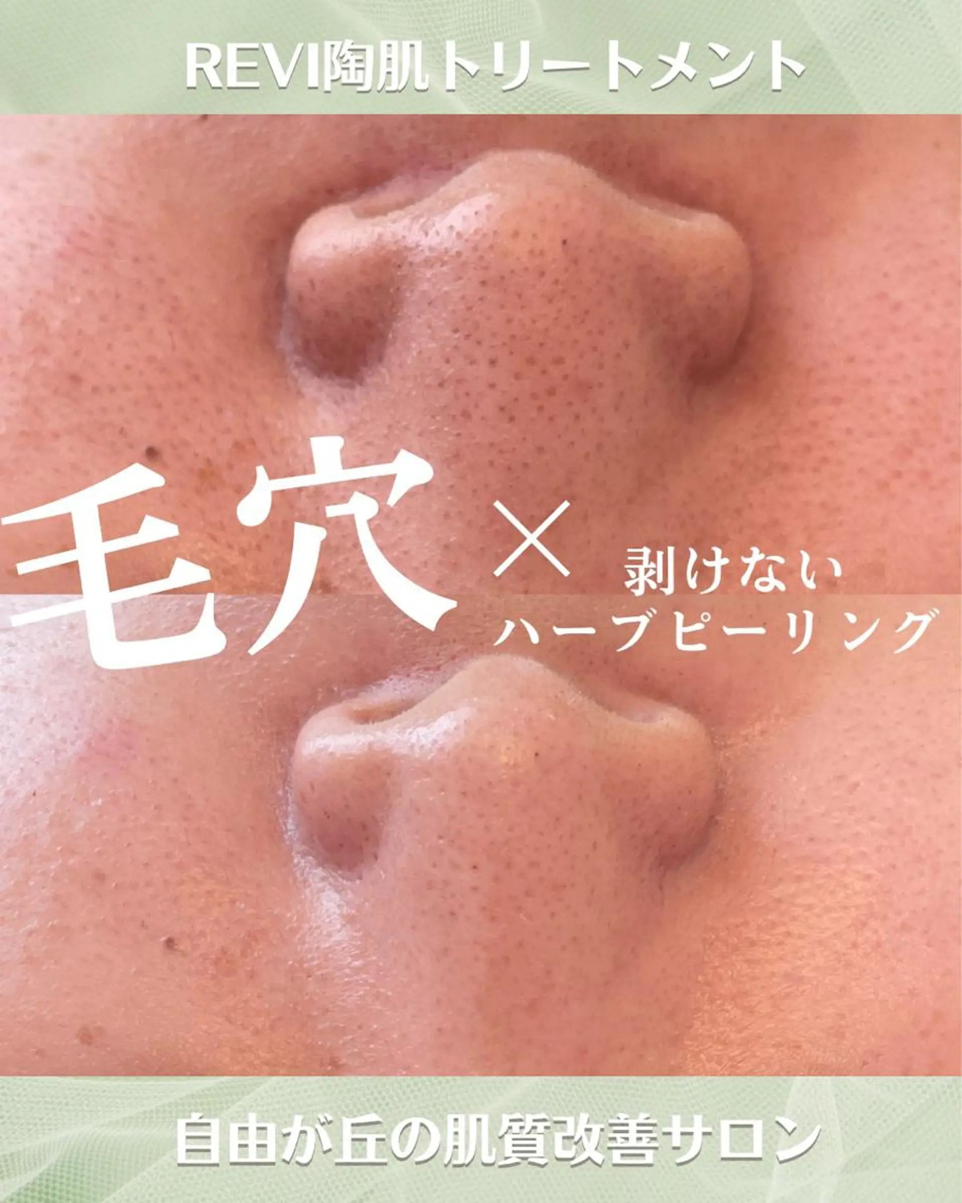 エステ ニキビ毛穴改善 🌿ハーブピーリングのエステ・リラクイメージ