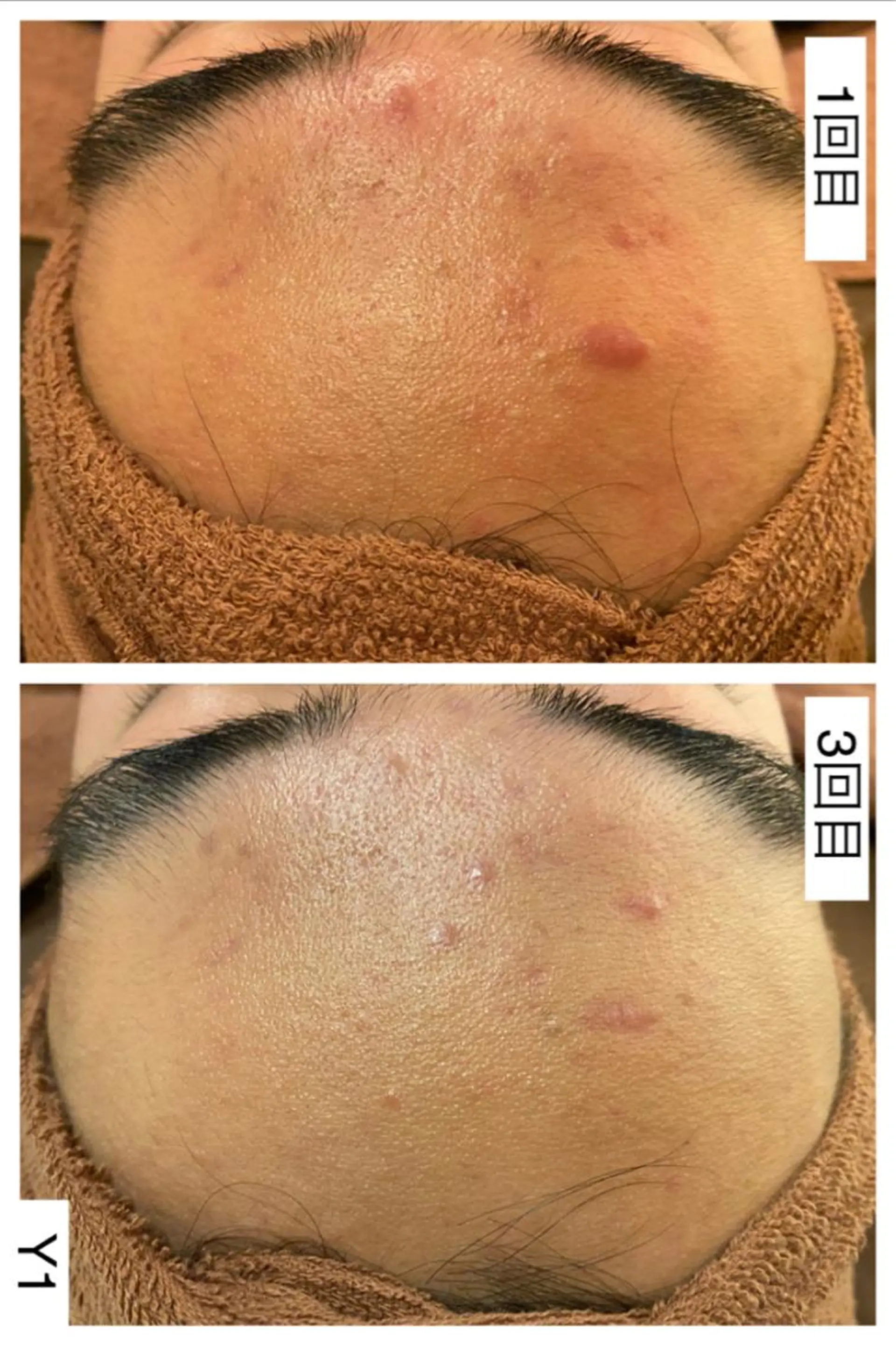 ショート カラー パーマ ヘアアレンジ メンズ キッズ ネイル マツエク・マツパ アイブロウ エステ リラク ニキビ特化型サロン 🌈20代ニキビ特化のエステ・リラクイメージ