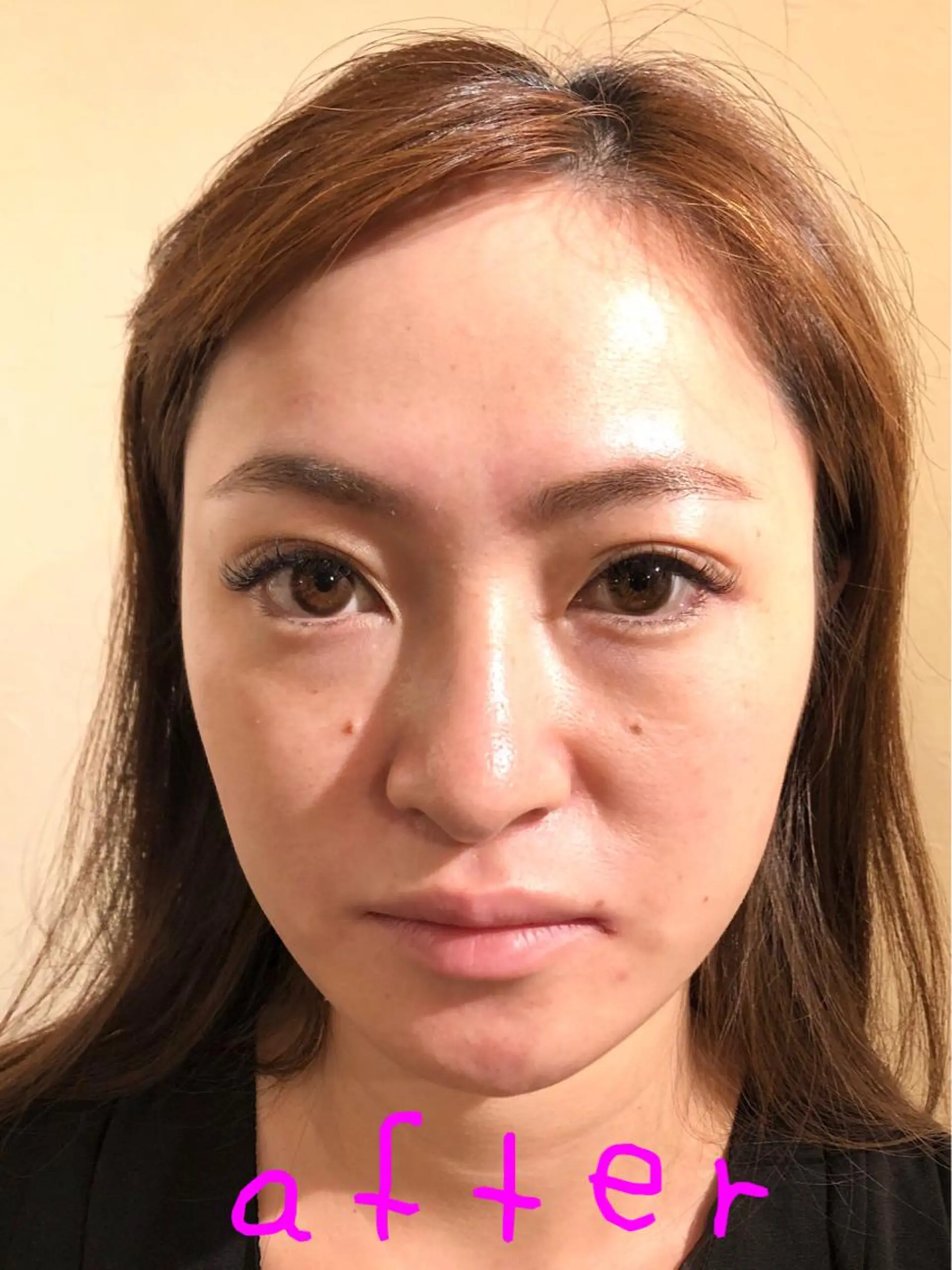 Acupuncture  salon LINOA リノア鍼灸院所属・ヘッドスパ鍼/小顔鍼 耳ツボ 　LINOAのエステ・リラクイメージ