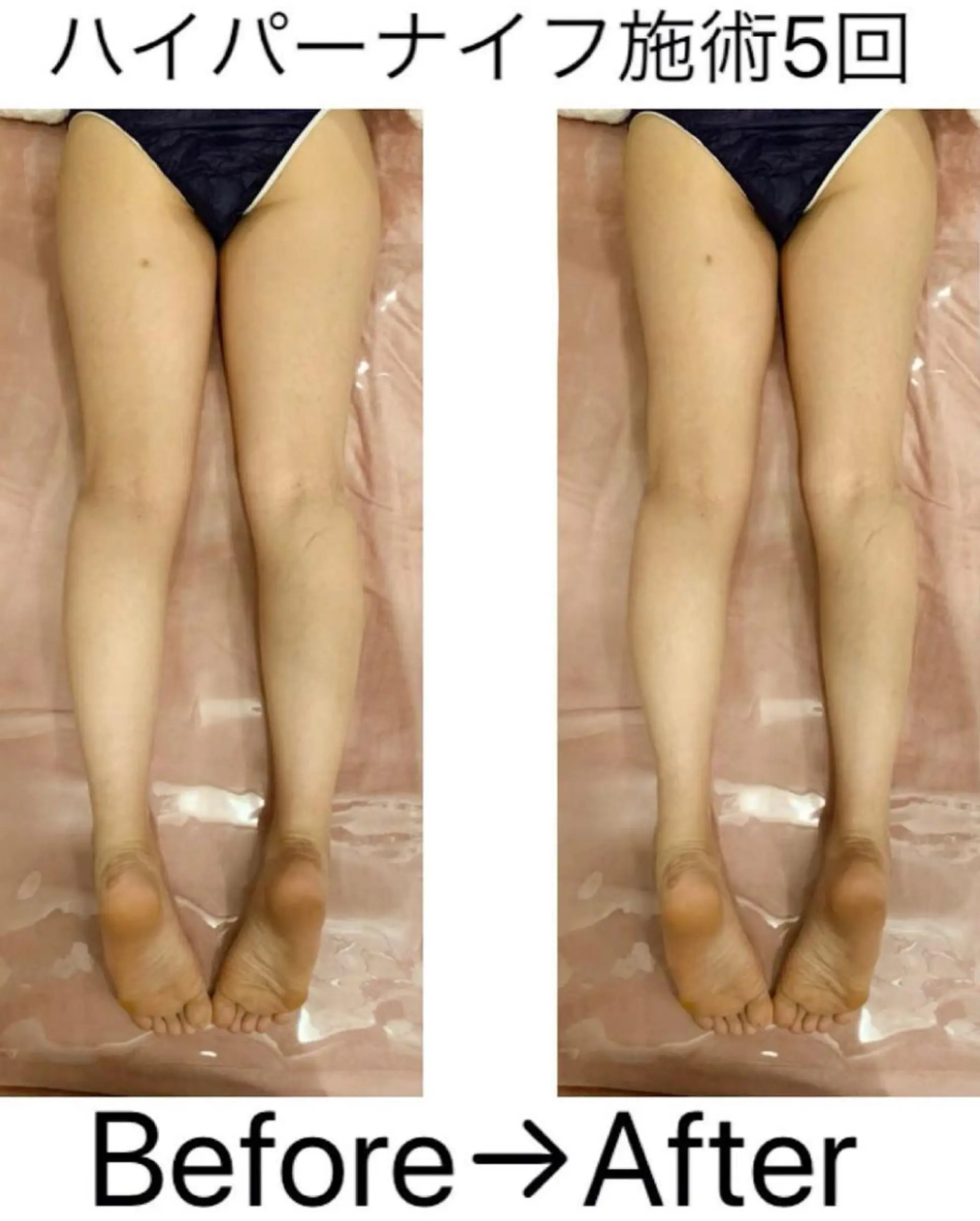 【ハイパーナイフ痩身&小顔コルギ&ハーブピーリング】K-Beauty　東新宿所属・kーbeauty痩身 フェイシャルのエステ・リラクイメージ