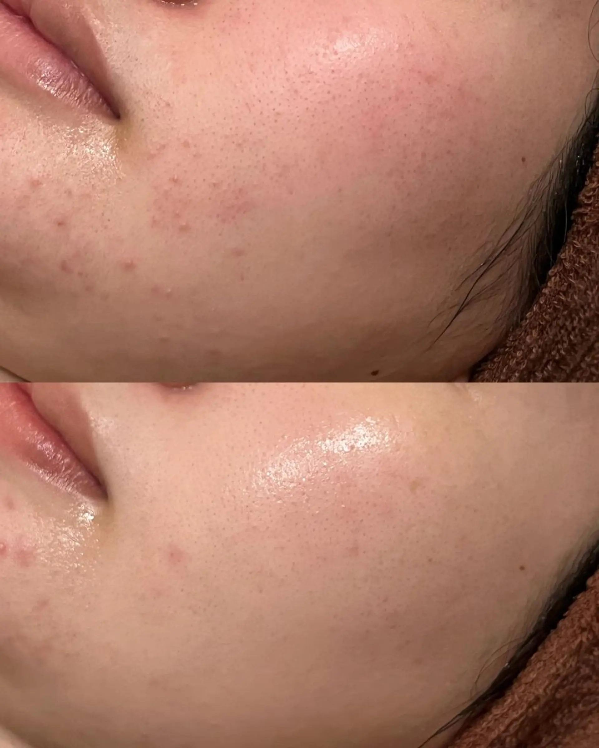 エステ リラク ニキビ跡改善専門🔥 医療にはできない改善のエステ・リラクイメージ