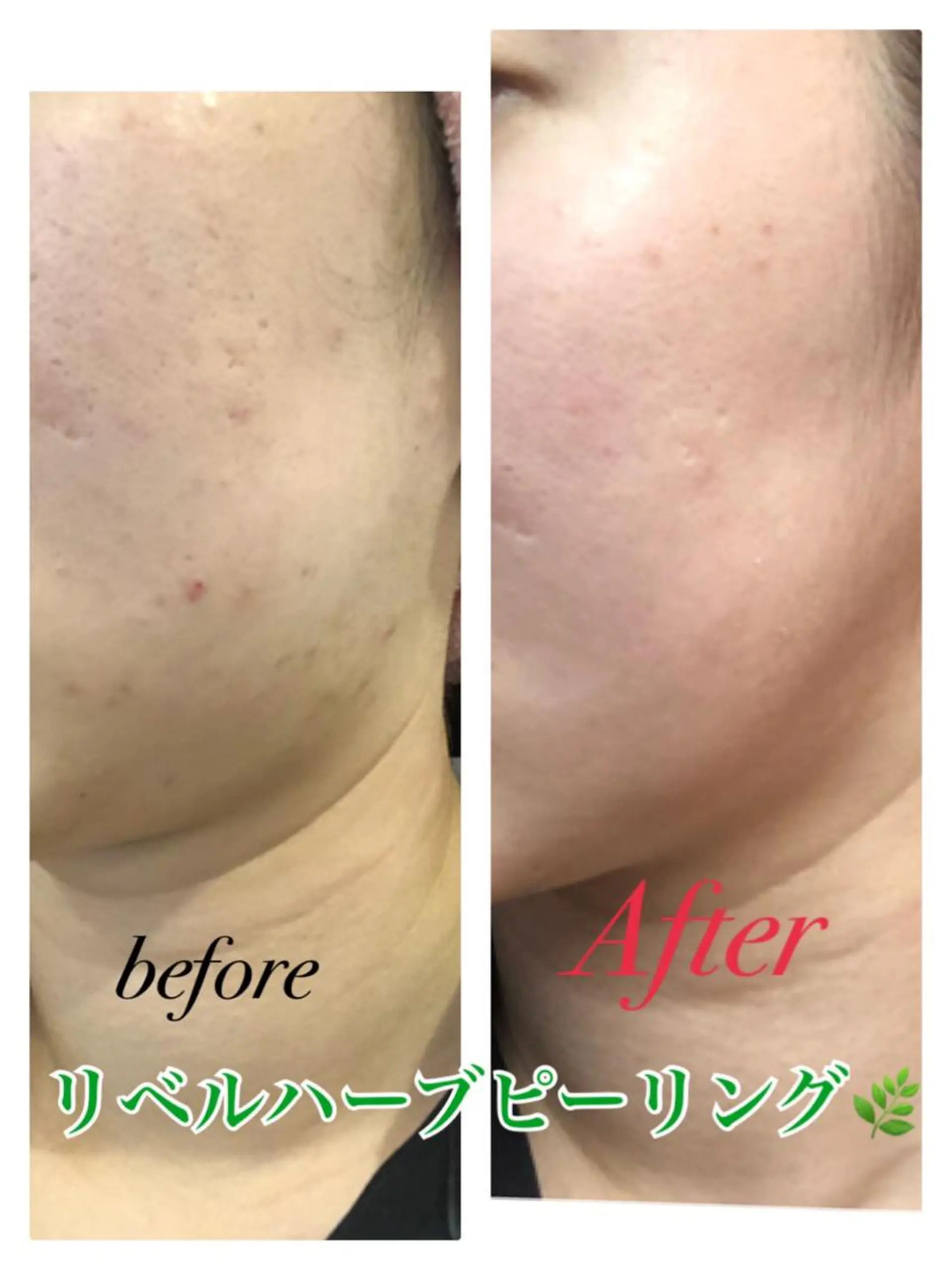 エステ 【リベルハーブピーリング認定店】敏感肌・美白脱毛専門店Dione立川店所属・Dione 立川店のエステ・リラクイメージ