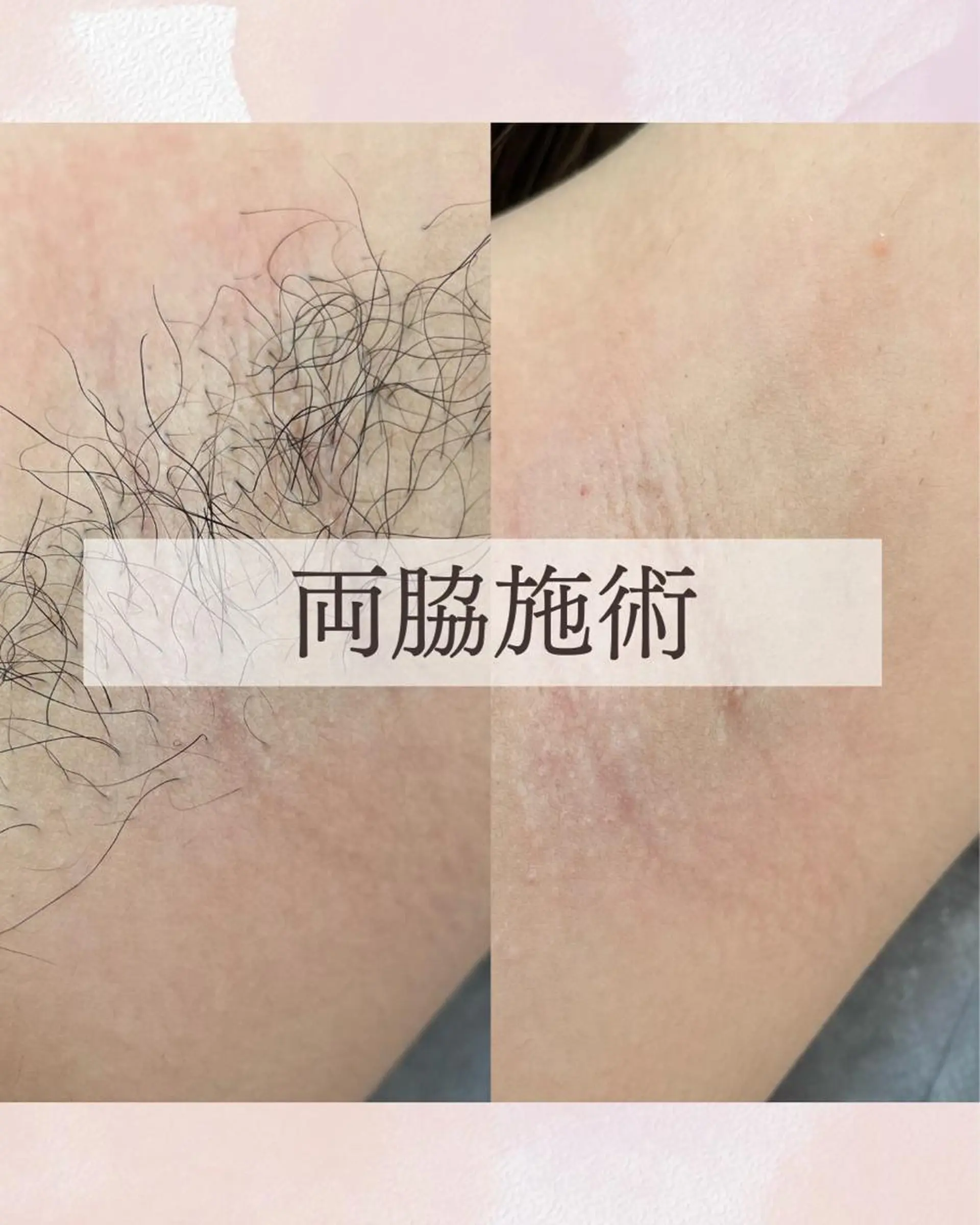 脱毛 Sugaring Hani Laniのエステ・リラクイメージ