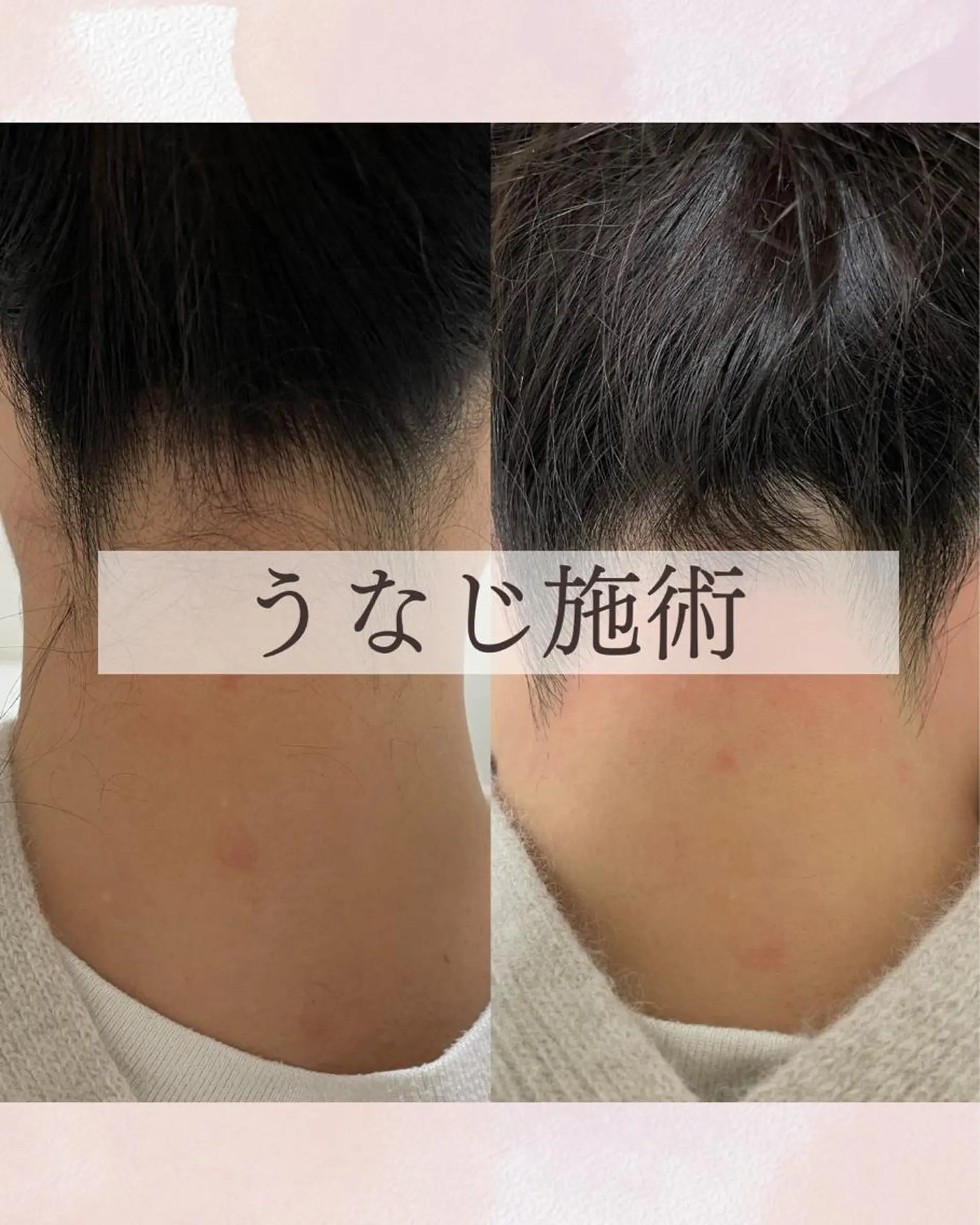 脱毛 Sugaring Hani Laniのエステ・リラクイメージ