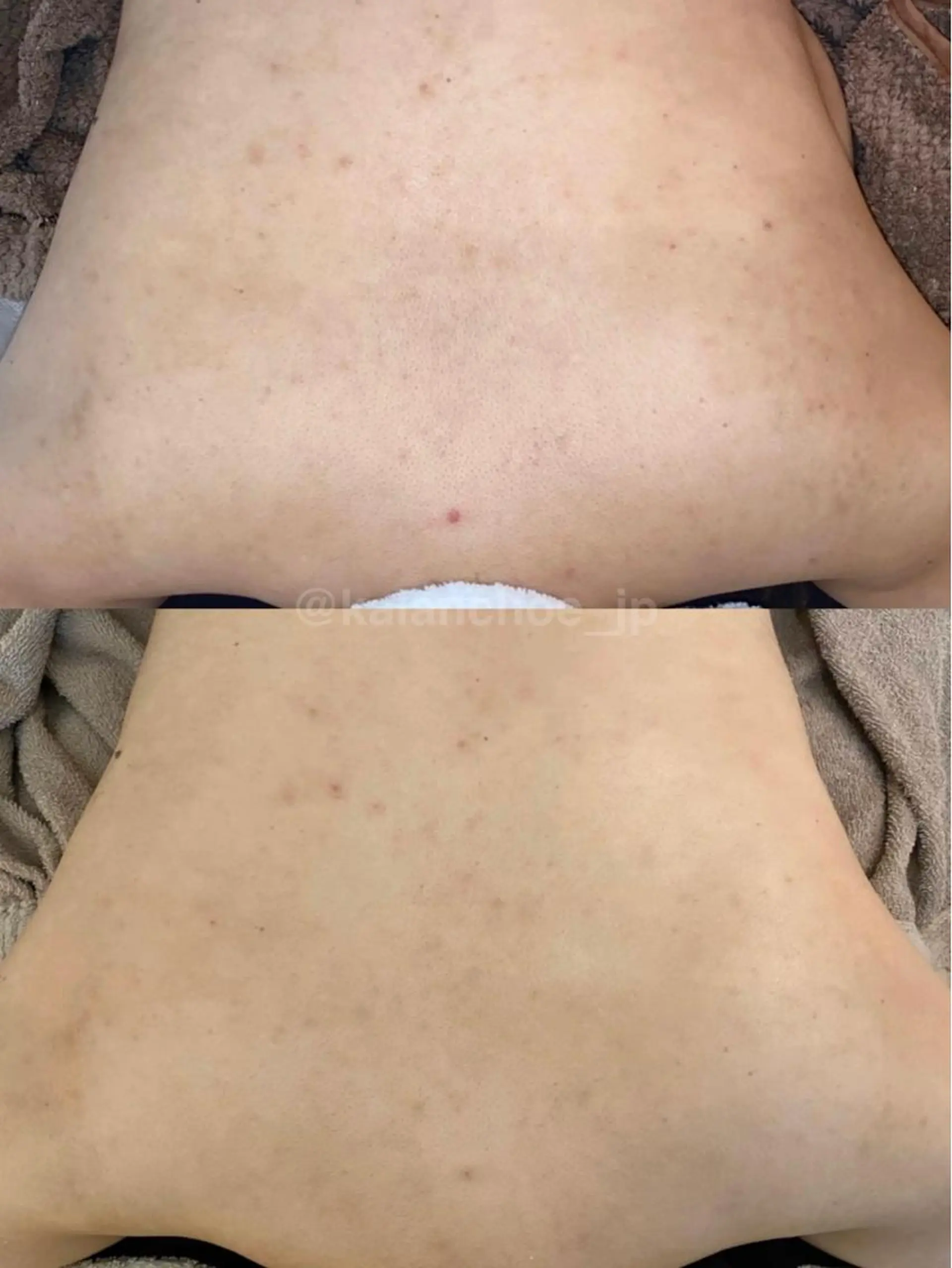 肌質改善 KALANCHOEのエステ・リラクイメージ