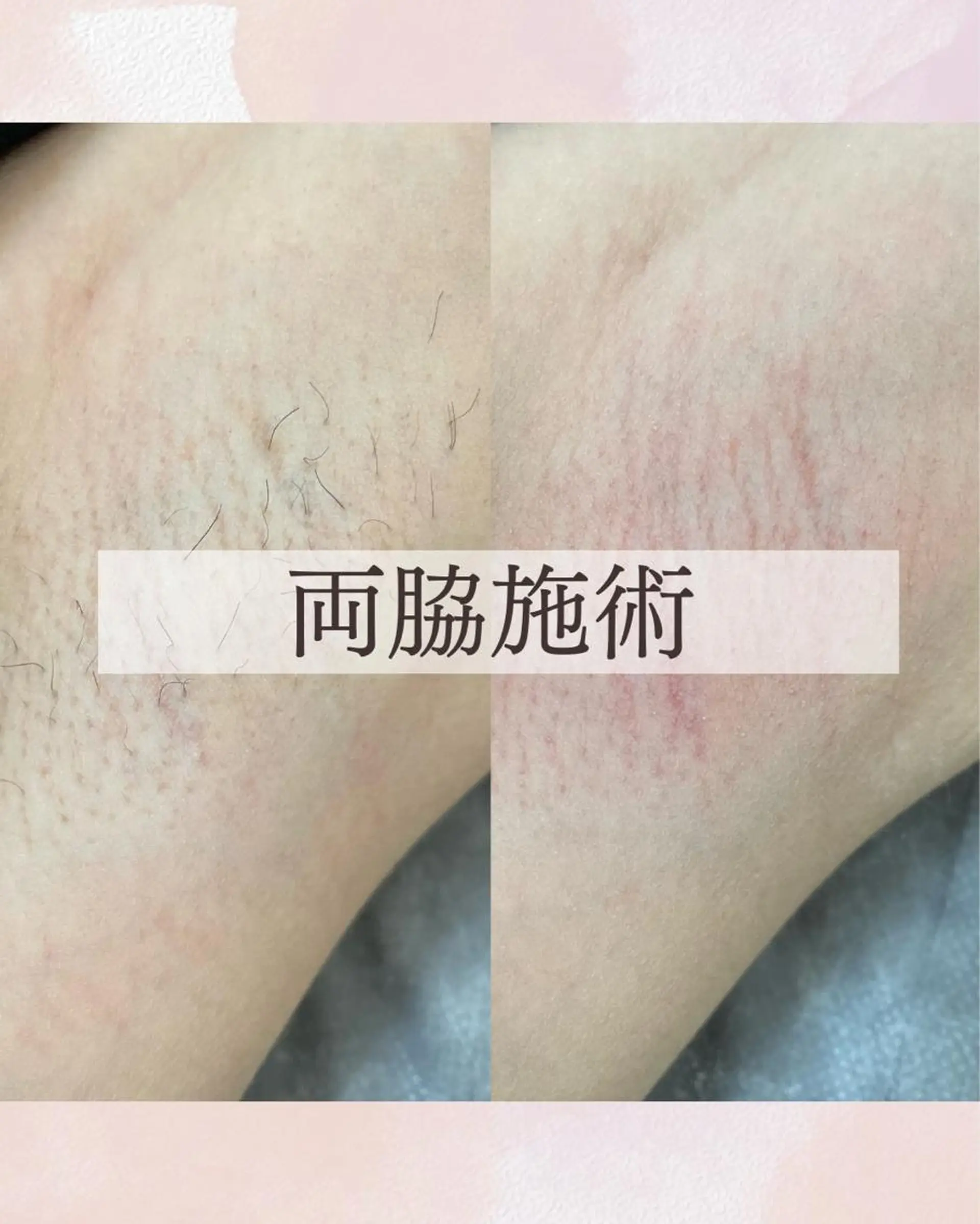 脱毛 Sugaring Hani Laniのエステ・リラクイメージ