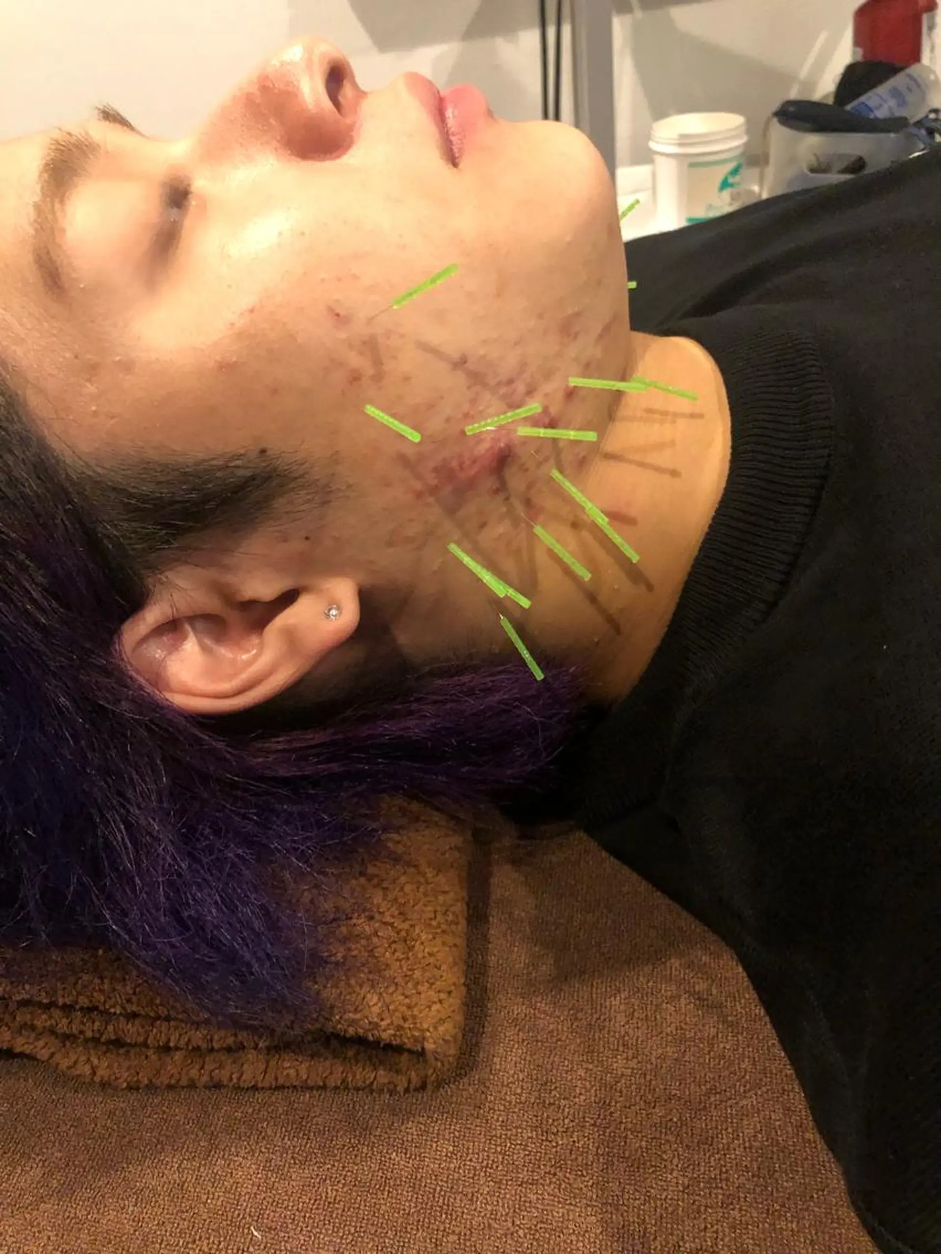 メンズ エステ リラク 美容鍼灸サロン LOMIHARIのエステ・リラクイメージ