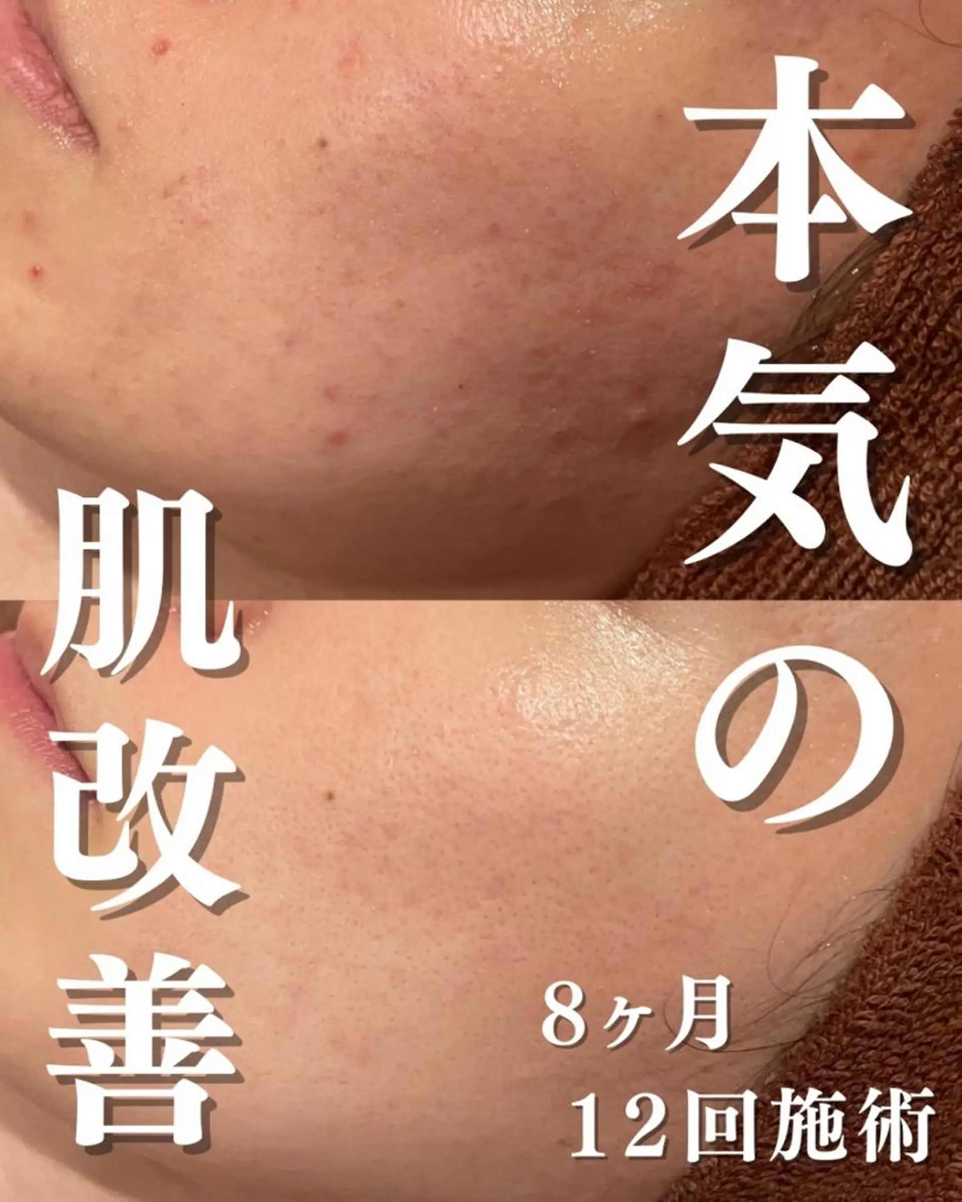 エステ リラク 撲滅🔥 最短ニキビ改善のエステ・リラクイメージ