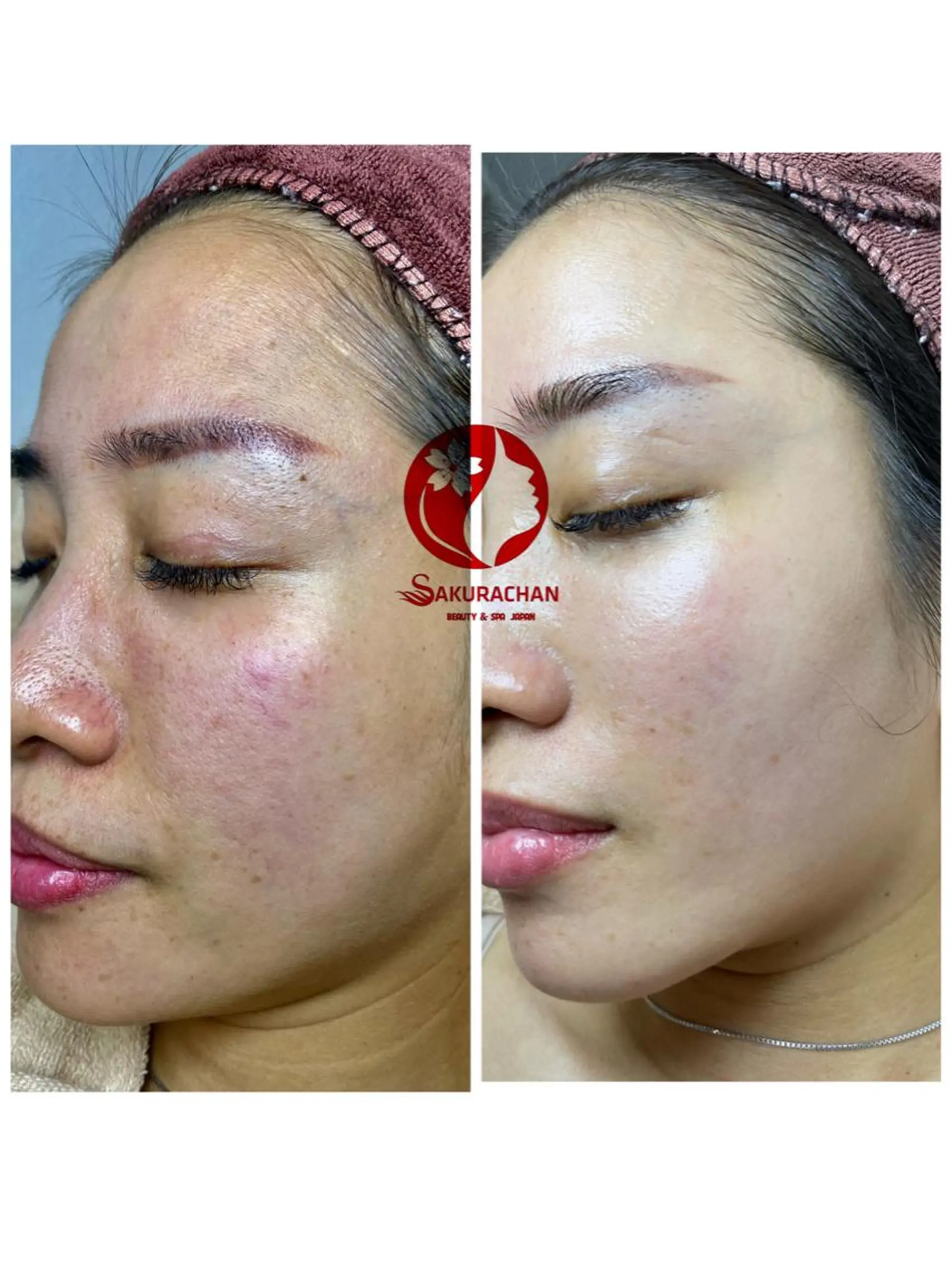 ニキビ、痩身、脱毛、 サクラチャンスパのエステ・リラクイメージ