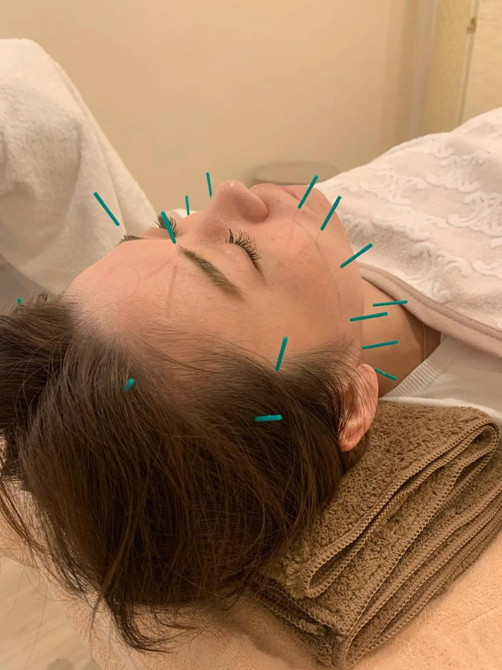 新宿hari-me所属・美容鍼hari-me 新宿のエステ・リラクイメージ