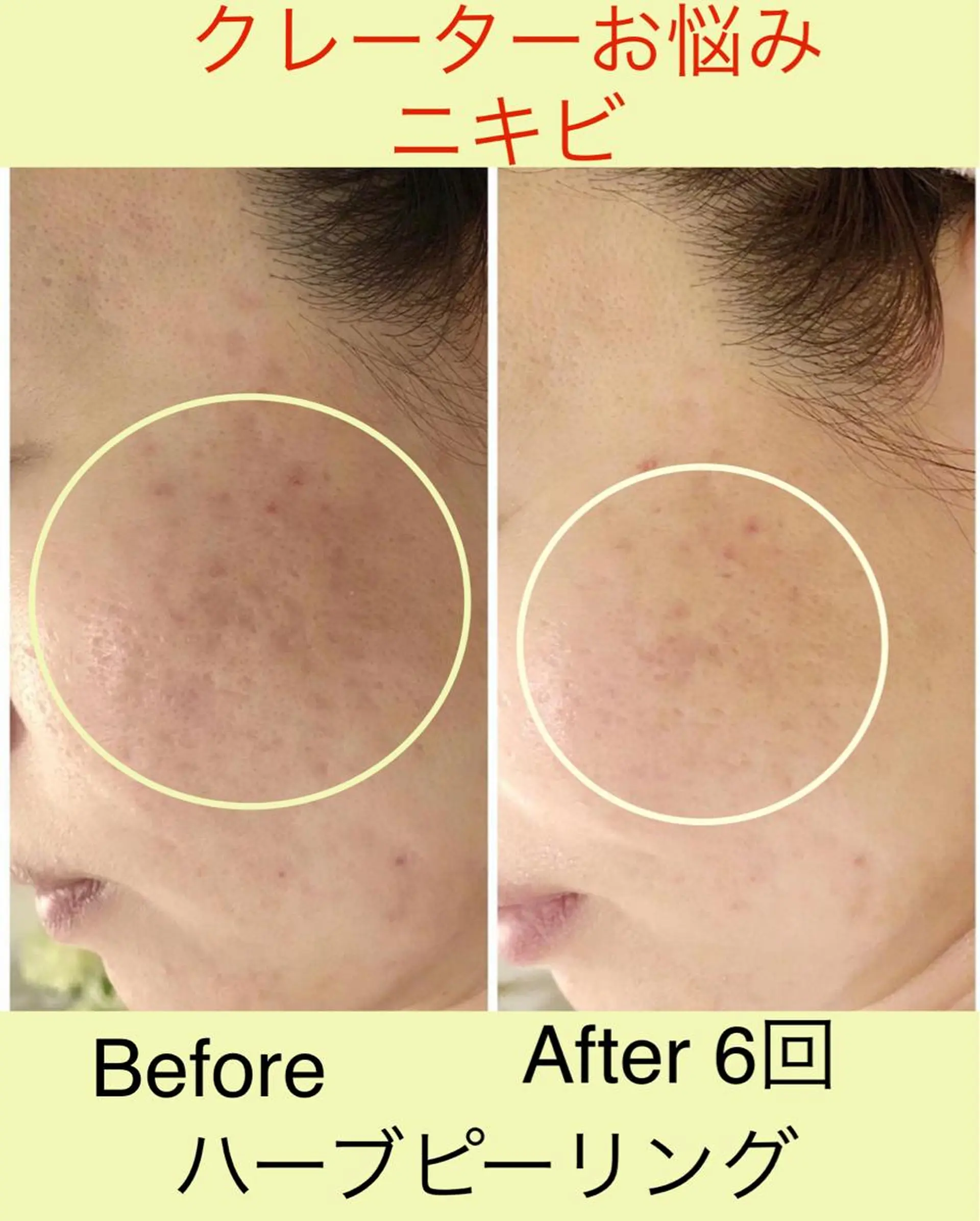 【ハイパーナイフ痩身&小顔コルギ&ハーブピーリング】K-Beauty　東新宿所属・kーbeauty痩身 フェイシャルのエステ・リラクイメージ