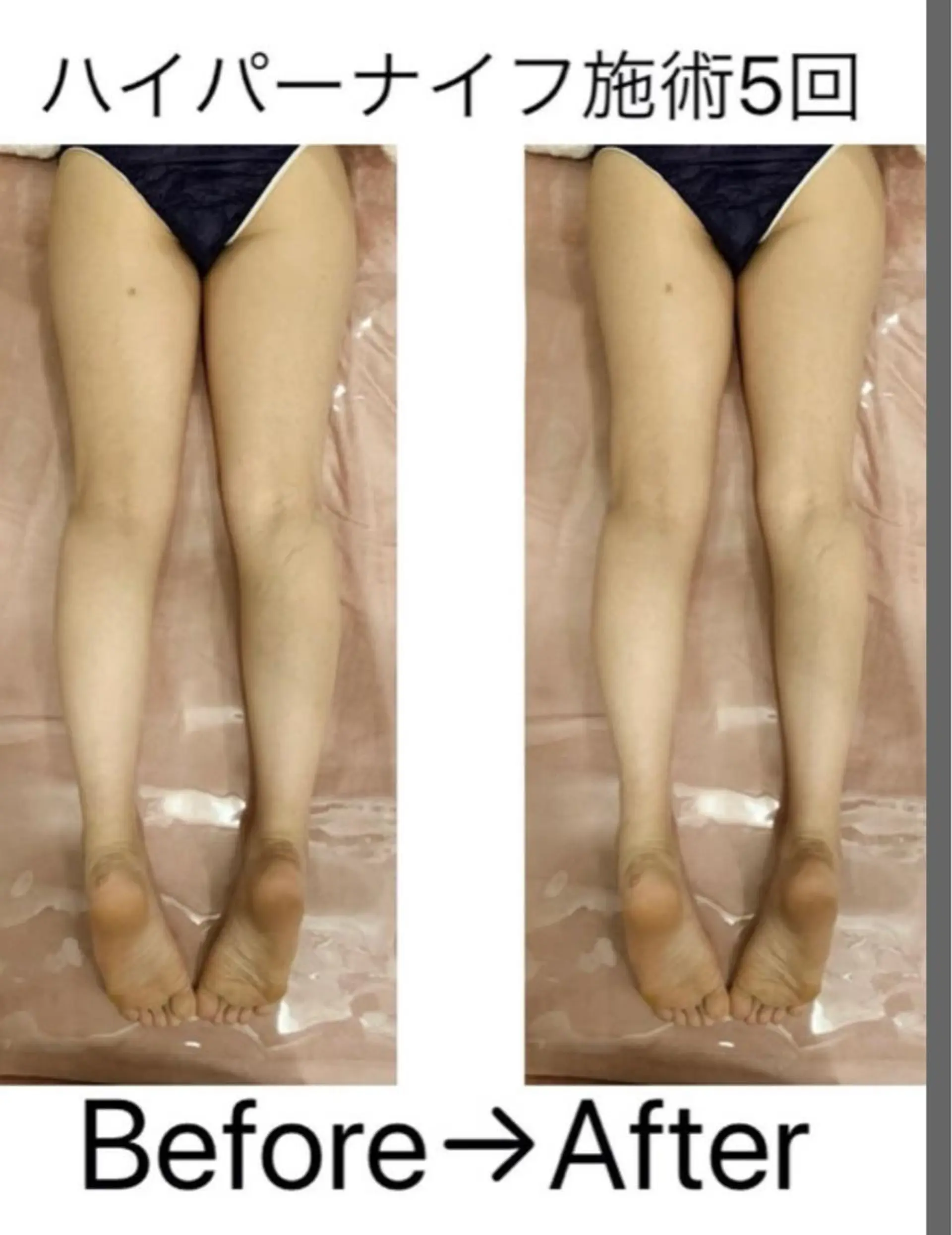 エステ リラク 【ハイパーナイフ痩身&小顔コルギ&ハーブピーリング】K-Beauty　東新宿所属・kーbeauty痩身 フェイシャルのエステ・リラクイメージ