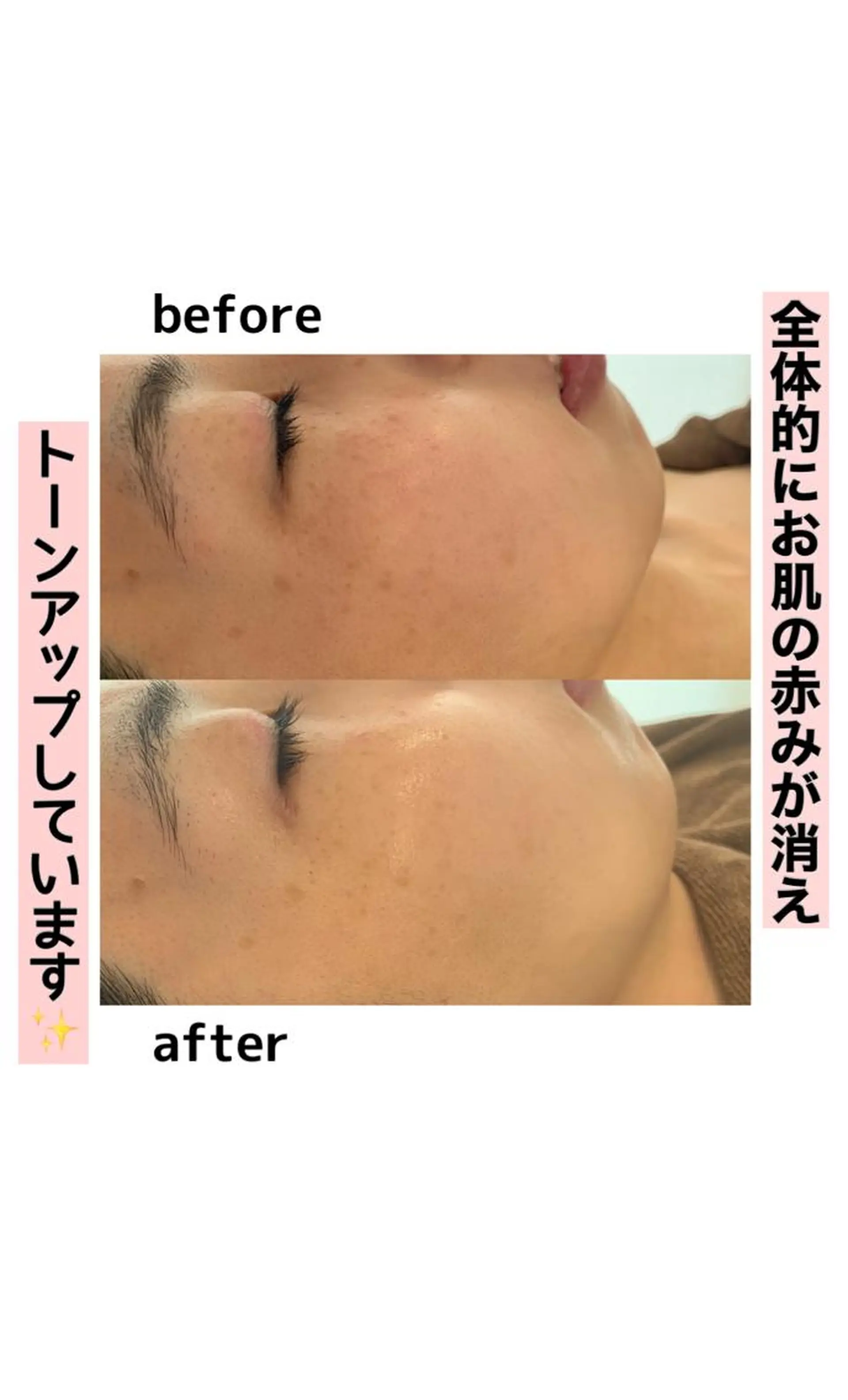 脱毛 美肌コラーゲン脱毛SINCERITE【サンセリテ】所属・瀬野 のぞみのエステ・リラクイメージ