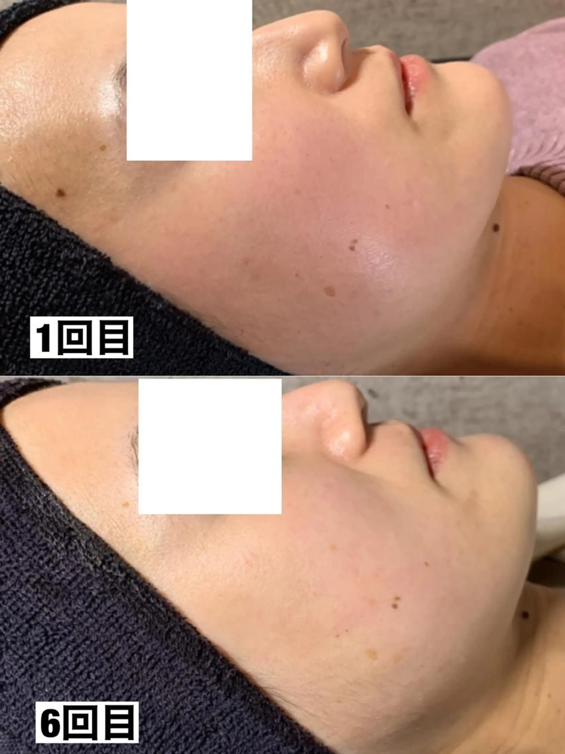 メンズ エステ リラク 姫路ハーブピーリング・韓国肌管理専門店Emotional所属・Yuka .のエステ・リラクイメージ